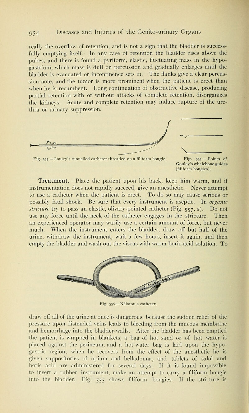 really the overflow of retention, and is not a sign that the bladder is success- fully emptying itself. In any case of retention the bladder rises above the pubes, and there is found a pyriform, elastic, fluctuating mass in the hypo- gastrium, which mass is dull on percussion and gradually enlarges until the bladder is evacuated or incontinence sets in. The flanks give a clear percus- sion-note, and the tumor is more prominent when the patient is erect than when he is recumbent. Long continuation of obstructive disease, producing partial retention with or without attacks of complete retention, disorganizes the kidneys. Acute and complete retention may induce rupture of the ure- thra or urinary suppression. U^ Fig. 554.—Gouley's tunnelled catheter threaded on a filiform bougie. V Fig- 555-— Points of Gouley 's whalebone guides (filiform bougies). Treatment.—Place the patient upon his back, keep him warm, and if instrumentation does not rapidly succeed, give an anesthetic. Never attempt to use a catheter when the patient is erect. To do so may cause serious or possibly fatal shock. Be sure that every instrument is aseptic. In organic stricture try to pass an elastic, olivary-pointed catheter (Fig. 557, a). Do not use any force until the neck of the catheter engages in the stricture. Then an experienced operator may warily use a certain amount of force, but never much. When the instrument enters the bladder, draw off but half of the urine, withdraw the instrument, wait a few hours, insert it again, and then empty the bladder and wash out the viscus with warm boric-acid solution. To Fig. 556.—Nelaton's catheter. draw off all of the urine at once is dangerous, because the sudden relief of the pressure upon distended veins leads to bleeding from the mucous membrane and hemorrhage into the bladder-walls. After the bladder has been emptied the patient is wrapped in blankets, a bag of hot sand or of hot water is placed against the perineum, and a hot-water bag is laid upon the hypo- gastric region; when he recovers from the effect of the anesthetic he is given suppositories of opium and belladonna, and tablets of salol and boric acid are administered for several days. If it is found impossible to insert a rubber instrument, make an attempt to carry a filiform bougie into the bladder. Fig. 555 shows filiform bougies. If the stricture is