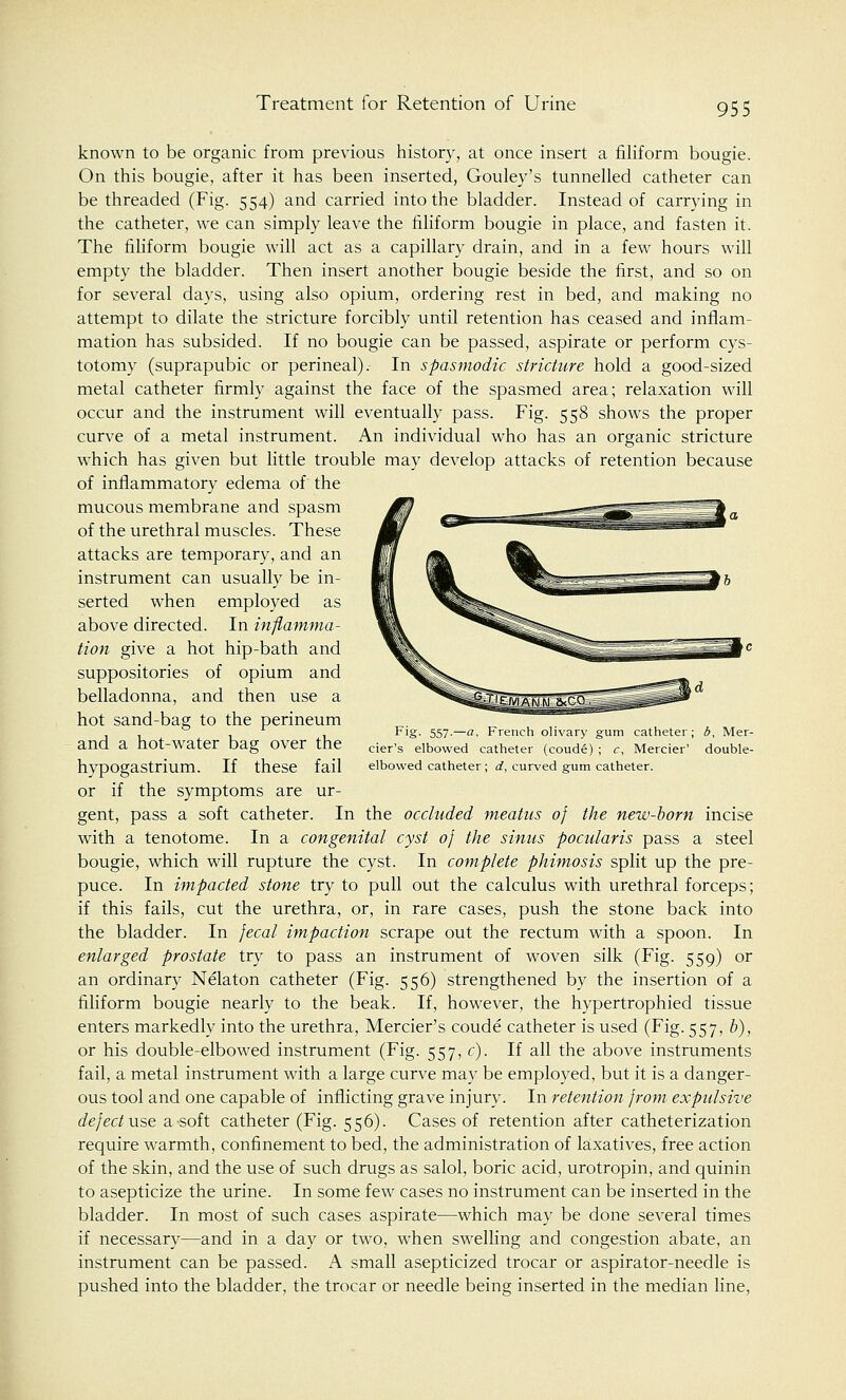 Treatment for Retention of Urine known to be organic from previous history, at once insert a filiform bougie. On this bougie, after it has been inserted, Gouley's tunnelled catheter can be threaded (Fig. 554) and carried into the bladder. Instead of carrying in the catheter, we can simply leave the filiform bougie in place, and fasten it. The filiform bougie will act as a capillary drain, and in a few hours will empty the bladder. Then insert another bougie beside the first, and so on for several days, using also opium, ordering rest in bed, and making no attempt to dilate the stricture forcibly until retention has ceased and inflam- mation has subsided. If no bougie can be passed, aspirate or perform cys- totomy (suprapubic or perineal). In spasmodic stricture hold a good-sized metal catheter firmly against the face of the spasmed area; relaxation will occur and the instrument will eventually pass. Fig. 558 shows the proper curve of a metal instrument. An individual who has an organic stricture which has given but little trouble may develop attacks of retention because of inflammatory edema of the mucous membrane and spasm of the urethral muscles. These attacks are temporary, and an instrument can usually be in- serted when employed as above directed. In inflamma- tion give a hot hip-bath and suppositories of opium and belladonna, and then use a hot sand-bag to the perineum and a hot-water bag over the hypogastrium. If these fail or if the symptoms are ur- gent, pass a soft catheter. In the occluded meatus of the new-born incise with a tenotome. In a congenital cyst of the sinus pocularis pass a steel bougie, which will rupture the cyst. In complete phimosis split up the pre- puce. In impacted stone try to pull out the calculus with urethral forceps; if this fails, cut the urethra, or, in rare cases, push the stone back into the bladder. In fecal impaction scrape out the rectum with a spoon. In enlarged prostate try to pass an instrument of woven silk (Fig. 559) or an ordinary Nelaton catheter (Fig. 556) strengthened by the insertion of a filiform bougie nearly to the beak. If, however, the hypertrophied tissue enters markedly into the urethra, Mercier's coude catheter is used (Fig. 557, b), or his double-elbowed instrument (Fig. 557, c). If all the above instruments fail, a metal instrument with a large curve may be employed, but it is a danger- ous tool and one capable of inflicting grave injury. In retention from expulsive defect use a soft catheter (Fig. 556). Cases of retention after catheterization require warmth, confinement to bed, the administration of laxatives, free action of the skin, and the use of such drugs as salol, boric acid, urotropin, and quinin to asepticize the urine. In some few cases no instrument can be inserted in the bladder. In most of such cases aspirate—which may be done several times if necessary—and in a day or two, when swelling and congestion abate, an instrument can be passed. A small asepticized trocar or aspirator-needle is pushed into the bladder, the trocar or needle being inserted in the median line, Fig- 557-—#. French olivary gum catheter; b, Mer- cier's elbowed catheter (coude) ; c, Mercier' double- elbowed catheter ; d, curved gum catheter.
