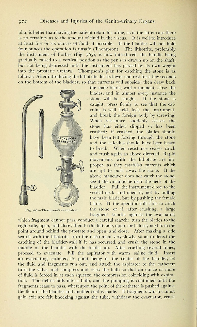 plan is better than having the patient retain his urine, as in the latter case there is no certainty as to the amount of fluid in the viscus. It is well to introduce at least five or six ounces of fluid, if possible. If the bladder will not hold four ounces the operation is unsafe (Thompson). The lithotrite, preferably the instrument of Forbes (Fig. 565), is now introduced, the handle being gradually raised to a vertical position as the penis is drawn up on the shaft, but not being depressed until the instrument has passed by its own weight into the prostatic urethra. Thompson's plan for catching the stone is as follows: After introducing the lithotrite, let its lower end rest for a few seconds on the bottom of the bladder, so that currents will subside; then draw back the male blade, wait a moment, close the blades, and in almost every instance the stone will be caught. If the stone is caught, press firmly to see that the cal- culus is well held, lock the instrument, and break the foreign body by screwing. When resistance suddenly ceases the stone has either slipped or has been crushed; if crushed, the blades should have been felt forcing through the stone and the calculus should have been heard to break. When resistance ceases catch and crush again as above directed. Rapid movements with the lithotrite are im- proper, as they establish currents which are apt to push away the stone. If the above maneuver does not catch the stone, see if the calculus be near the neck of the bladder. Pull the instrument close to the vesical neck, and open it, not by pulling the male blade, but by pushing the female blade. If the operator still fails to catch the stone, or if, after crushing, a large fragment knocks against the evacuator, which fragment cannot pass, conduct a careful search: turn the blades to the right side, open, and close; then to the left side, open, and close; next turn the point around behind the prostate and open, and close. After making a side search with the lithotrite, turn the instrument very slowly, so as to detect the catching of the bladder-wall if it has occurred, and crush the stone in the middle of the bladder with the blades up. After crushing several times, proceed to evacuate. Fill the aspirator with warm saline fluid. Insert an evacuating catheter, its point being in the center of the bladder, let the fluid and fragments run out, and attach the aspirator to the catheter; turn the valve, and compress and relax the bulb so that an ounce or more of fluid is forced in at each squeeze, the compression coinciding with expira- tion. The debris falls into a bulb, and the pumping is continued until the fragments cease to pass, whereupon the point of the catheter is pushed against the floor of the bladder and another trial is made. If fragments which cannot gain exit are felt knocking against the tube, withdraw the evacuator, crush Fig. 566.—Thompson's evacuator.
