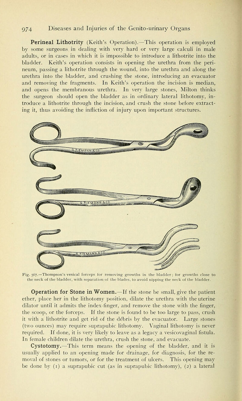 Perineal Lithotrity (Keith's Operation).—This operation is employed by some surgeons in dealing with very hard or very large calculi in male adults, or in cases in which it is impossible to introduce a lithotrite into the bladder. Keith's operation consists in opening the urethra from the peri- neum, passing a lithotrite through the wound, into the urethra and along the urethra into the bladder, and crushing the stone, introducing an evacuator and removing the fragments. In Keith's operation the incision is median, and opens the membranous urethra. In very large stones, Milton thinks the surgeon should open the bladder as in ordinary lateral lithotomy, in- troduce a lithotrite through the incision, and crush the stone before extract- ing it, thus avoiding the infliction of injury upon important structures. Fig. 567.—Thompson's vesical forceps for removing growths in the bladder; for growths close to the neck of the bladder, with separation of the blades, to avoid nipping the neck of the bladder. Operation for Stone in Women.—If the stone be small, give the patient ether, place her in the lithotomy position, dilate the urethra with the uterine dilator until it admits the index-finger, and remove the stone with the finger, the scoop, or the forceps. If the stone is found to be too large to pass, crush it with a lithotrite and get rid of the debris by the evacuator. Large stones (two ounces) may require suprapubic lithotomy. Vaginal lithotomy is never required. If done, it is very likely to leave as a legacy a vesicovaginal fistula. In female children dilate the urethra, crush the stone, and evacuate. Cystotomy.—This term means the opening of the bladder, and it is usually applied to an opening made for drainage, for diagnosis, for the re- moval of stones or tumors, or for the treatment of ulcers. This opening may be done by (1) a suprapubic cut (as in suprapubic lithotomy), (2) a lateral