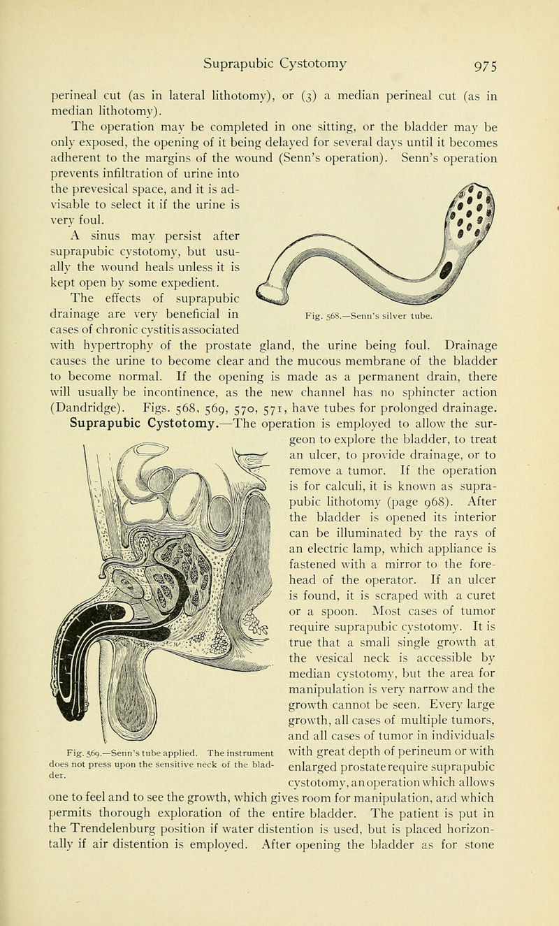 Fig. 568.—Senn's silver tube. perineal cut (as in lateral lithotomy), or (3) a median perineal cut (as in median lithotomy). The operation may be completed in one sitting, or the bladder may be only exposed, the opening of it being delayed for several days until it becomes adherent to the margins of the wound (Senn's operation). Senn's operation prevents infiltration of urine into the prevesical space, and it is ad- visable to select it if the urine is very foul. A sinus may persist after suprapubic cystotomy, but usu- ally the wound heals unless it is kept open by some expedient. The effects of suprapubic drainage are very beneficial in cases of chronic cystitis associated with hypertrophy of the prostate gland, the urine being foul. Drainage causes the urine to become clear and the mucous membrane of the bladder to become normal. If the opening is made as a permanent drain, there will usually be incontinence, as the new channel has no sphincter action (Dandridge). Figs. 568, 569, 570, 571, have tubes for prolonged drainage. Suprapubic Cystotomy.—The operation is employed to allow the sur- geon to explore the bladder, to treat an ulcer, to provide drainage, or to remove a tumor. If the operation is for calculi, it is known as supra- pubic lithotomy (page 968). After the bladder is opened its interior can be illuminated by the rays of an electric lamp, which appliance is fastened with a mirror to the fore- head of the operator. If an ulcer is found, it is scraped with a curet or a spoon. Most cases of tumor require suprapubic cystotomy. It is true that a small single growth at the vesical neck is accessible by median cystotomy, but the area for manipulation is very narrow and the growth cannot be seen. Every large growth, all cases of multiple tumors, and all cases of tumor in individuals with great depth of perineum or with enlarged prostate require suprapubic cystotomy, an operation which allows one to feel and to see the growth, which gives room for manipulation, and which permits thorough exploration of the entire bladder. The patient is put in the Trendelenburg position if water distention is used, but is placed horizon- tally if air distention is employed. After opening the bladder as for stone Fig. 569.—Senn's tube applied. The instrument does not press upon the sensitive neck of the blad- der.