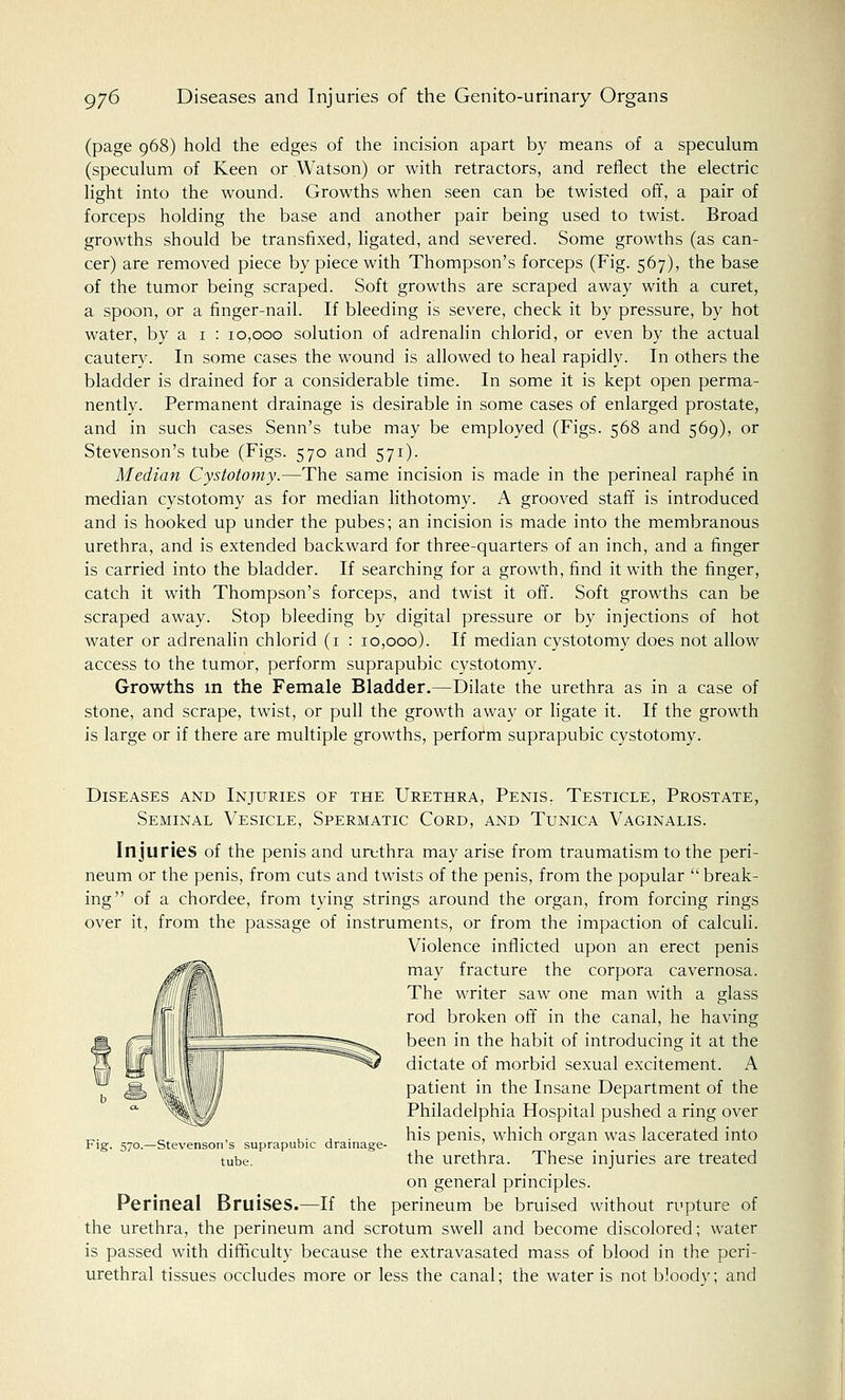 (page 968) hold the edges of the incision apart by means of a speculum (speculum of Keen or Watson) or with retractors, and reflect the electric light into the wound. Growths when seen can be twisted off, a pair of forceps holding the base and another pair being used to twist. Broad growths should be transfixed, ligated, and severed. Some growths (as can- cer) are removed piece by piece with Thompson's forceps (Fig. 567), the base of the tumor being scraped. Soft growths are scraped away with a curet, a spoon, or a finger-nail. If bleeding is severe, check it by pressure, by hot water, by a 1 : 10,000 solution of adrenalin chlorid, or even by the actual cautery. In some cases the wound is allowed to heal rapidly. In others the bladder is drained for a considerable time. In some it is kept open perma- nently. Permanent drainage is desirable in some cases of enlarged prostate, and in such cases Senn's tube may be employed (Figs. 568 and 569), or Stevenson's tube (Figs. 570 and 571). Median Cystotomy.—The same incision is made in the perineal raphe in median cystotomy as for median lithotomy. A grooved staff is introduced and is hooked up under the pubes; an incision is made into the membranous urethra, and is extended backward for three-quarters of an inch, and a finger is carried into the bladder. If searching for a growth, find it with the finger, catch it with Thompson's forceps, and twist it off. Soft growths can be scraped away. Stop bleeding by digital pressure or by injections of hot water or adrenalin chlorid (1 : 10,000). If median cystotomy does not allow access to the tumor, perform suprapubic cystotomy. Growths in the Female Bladder.—Dilate the urethra as in a case of stone, and scrape, twist, or pull the growth away or ligate it. If the growth is large or if there are multiple growths, perfofm suprapubic cystotomy. Diseases and Injuries of the Urethra, Penis, Testicle, Prostate, Seminal Vesicle, Spermatic Cord, and Tunica Vaginalis. Injuries of the penis and urtthra may arise from traumatism to the peri- neum or the penis, from cuts and twists of the penis, from the popular  break- ing of a chordee, from tying strings around the organ, from forcing rings over it, from the passage of instruments, or from the impaction of calculi. Violence inflicted upon an erect penis may fracture the corpora cavernosa. The writer saw one man with a glass rod broken off in the canal, he having been in the habit of introducing it at the dictate of morbid sexual excitement. A patient in the Insane Department of the Philadelphia Hospital pushed a ring over his penis, which organ was lacerated into the urethra. These injuries are treated on general principles. Perineal Bruises.—If the perineum be bruised without rupture of the urethra, the perineum and scrotum swell and become discolored; water is passed with difficulty because the extravasated mass of blood in the peri- urethral tissues occludes more or less the canal; the water is not b!oodv; and Fig. 570.—Stevenson's suprapubic drainage- tube.
