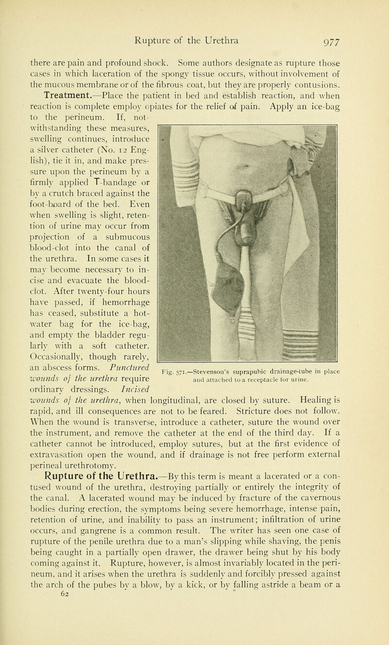 there are pain and profound shock. Some authors designate as rupture those cases in which laceration of the spongy tissue occurs, without involvement of the mucous membrane or of the fibrous coat, but they are properly contusions. Treatment.—Place the patient in bed and establish reaction, and when reaction is complete employ opiates for the relief of pain. Apply an ice-bag to the perineum. If, not- withstanding these measures, swelling continues, introduce a silver catheter (No. 12 Eng- lish), tie it in, and make pres- sure upon the perineum by a firmly applied T-bandage or by a crutch braced against the foot-board of the bed. Even when swelling is slight, reten- tion of urine may occur from projection of a submucous blood-clot into the canal of the urethra. In some cases it may become necessary to in- cise and evacuate the blood- clot. After twenty-four hours have passed, if hemorrhage has ceased, substitute a hot- water bag for the ice-bag, and empty the bladder regu- larly with a soft catheter. Occasionally, though rarely, an abscess forms. Punctured wounds of the urethra require ordinary dressings. Incised wounds of the urethra, when longitudinal, are closed by suture. Healing is rapid, and ill consequences are not to be feared. Stricture does not follow. When the wound is transverse, introduce a catheter, suture the wound over the instrument, and remove the catheter at the end of the third day. If a catheter cannot be introduced, employ sutures, but at the first evidence of extravasation open the wound, and if drainage is not free perform external perineal urethrotomy. Rupture of the Urethra.—By this term is meant a lacerated or a con- tused wound of the urethra, destroying partially or entirely the integrity of the canal. A lacerated wound may be induced by fracture of the cavernous bodies during erection, the symptoms being severe hemorrhage, intense pain, retention of urine, and inability to pass an instrument; infiltration of urine occurs, and gangrene is a common result. The writer has seen one case of rupture of the penile urethra due to a man's slipping while shaving, the penis being caught in a partially open drawer, the drawer being shut by his body coming against it. Rupture, however, is almost invariably located in the peri- neum, and it arises when the urethra is suddenly and forcibly pressed against the arch of the pubes by a blow, by a kick, or bv falling astride a beam or a 62 Stevenson's suprapubic drainage-cube in place and attached to a receptacle for urine.