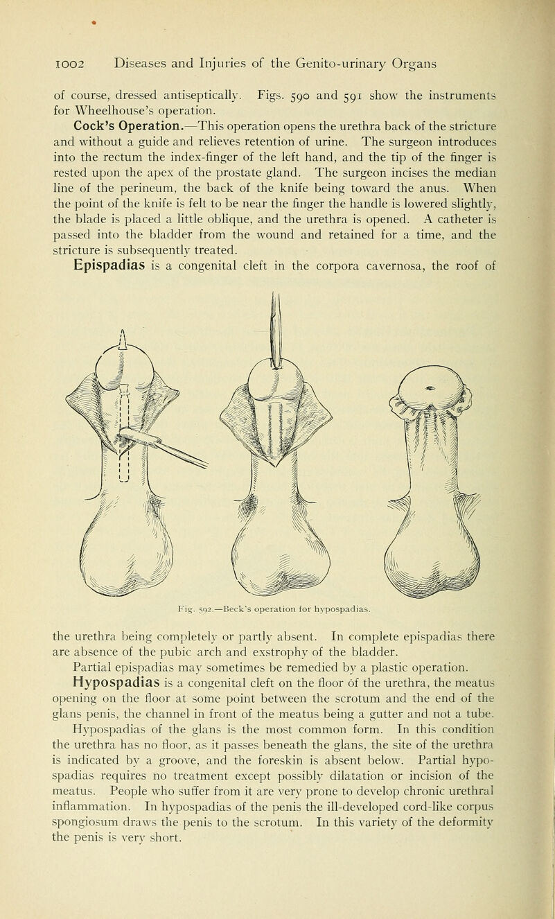 of course, dressed antiseptically. Figs. 590 and 591 show the instruments for Wheelhouse's operation. Cock's Operation.—This operation opens the urethra back of the stricture and without a guide and relieves retention of urine. The surgeon introduces into the rectum the index-finger of the left hand, and the tip of the finger is rested upon the apex of the prostate gland. The surgeon incises the median line of the perineum, the back of the knife being toward the anus. When the point of the knife is felt to be near the finger the handle is lowered slightly, the blade is placed a little oblique, and the urethra is opened. A catheter is passed into the bladder from the wound and retained for a time, and the stricture is subsequently treated. Epispadias is a congenital cleft in the corpora cavernosa, the roof of Fig. 592.—Beck's operation for hypospadias. the urethra being completely or partly absent. In complete epispadias there are absence of the pubic arch and exstrophy of the bladder. Partial epispadias may sometimes be remedied by a plastic operation. Hypospadias is a congenital cleft on the floor of the urethra, the meatus opening on the floor at some point between the scrotum and the end of the glans penis, the channel in front of the meatus being a gutter and not a tube. Hypospadias of the glans is the most common form. In this condition the urethra has no floor, as it passes beneath the glans, the site of the urethra is indicated by a groove, and the foreskin is absent below. Partial hypo- spadias requires no treatment except possibly dilatation or incision of the meatus. People who suffer from it are very prone to develop chronic urethral inflammation. In hypospadias of the penis the ill-developed cord-like corpus spongiosum draws the penis to the scrotum. In this variety of the deformity the penis is very short.