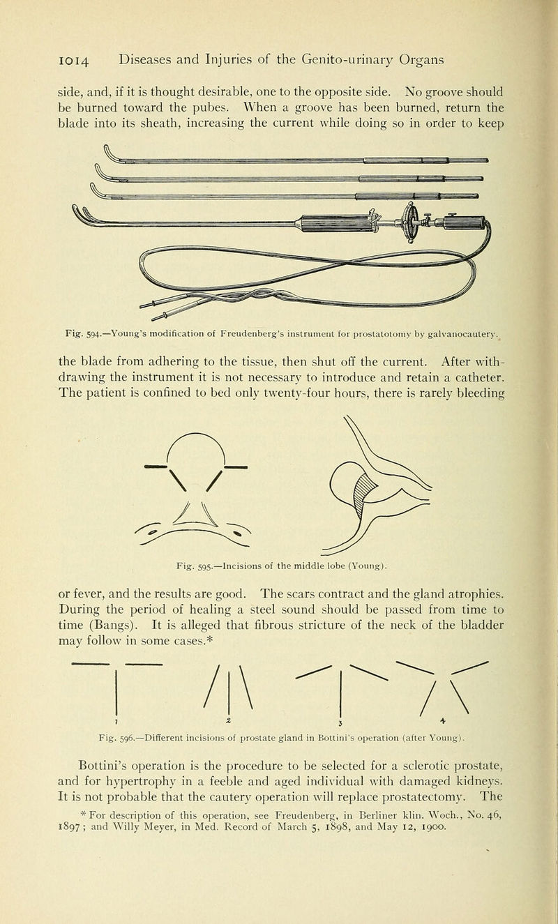 side, and, if it is thought desirable, one to the opposite side. No groove should be burned toward the pubes. When a groove has been burned, return the blade into its sheath, increasing the current while doing so in order to keep Fig. 594.—Young's modification of Freudenberg's instrument for prostatotomy by galvanocautery. the blade from adhering to the tissue, then shut off the current. After with- drawing the instrument it is not necessary to introduce and retain a catheter. The patient is confined to bed only twenty-four hours, there is rarely bleeding \ / Fig. 595.—Incisions of the middle lobe (Young). or fever, and the results are good. The scars contract and the gland atrophies. During the period of healing a steel sound should be passed from time to time (Bangs). It is alleged that fibrous stricture of the neck of the bladder may follow in some cases.* Fig. 596.—Different incisions of prostate gland in Bottini's operation (after Young). Bottini's operation is the procedure to be selected for a sclerotic prostate, and for hypertrophy in a feeble and aged individual with damaged kidneys. It is not probable that the cautery operation will replace prostatectomy. The * For description of this operation, see Freudenberg, in Berliner klin. Woch., No. 46, 1897 ; and Willy Meyer, in Med. Record of March 5, 1898, and May 12, 1900.