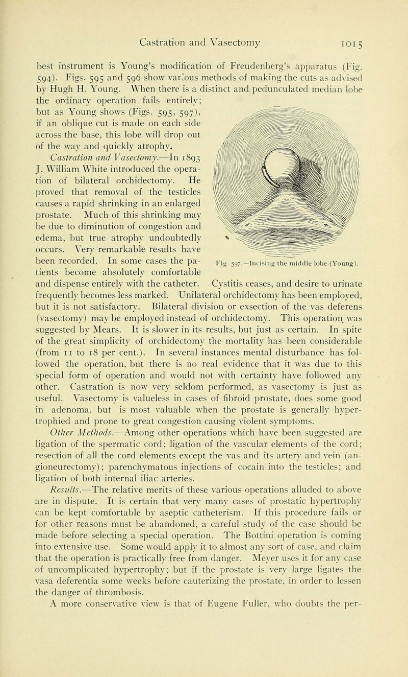 Incising the middle lobe (Young). best instrument is Young's modification of Freudenberg's apparatus (Fig. 594). Figs. 595 and 596 show various methods of making the cuts as advised by Hugh H. Young. When there is a distinct and pedunculated median lobe the ordinary operation fails entirely; but as Young shows (Figs. 595, 597), if an oblique cut is made on each side across the base, this lobe will drop out of the way and quickly atrophy. Castration and Vasectomy.—In 1893 J. William White introduced the opera- tion of bilateral orchidectomy. He proved that removal of the testicles causes a rapid shrinking in an enlarged prostate. Much of this shrinking may be due to diminution of congestion and edema, but true atrophy undoubtedly occurs. Very remarkable results have been recorded. In some cases the pa- tients become absolutely comfortable and dispense entirely with the catheter. Cystitis ceases, and desire to urinate frequently becomes less marked. Unilateral orchidectomy has been employed, but it is not satisfactory. Bilateral division or exsection of the vas deferens (vasectomy) may be employed instead of orchidectomy. This operation was suggested by Mears. It is slower in its results, but just as certain. In spite of the great simplicity of orchidectomy the mortality has been considerable (from 11 to 18 per cent.). In several instances mental disturbance has fol- lowed the operation, but there is no real evidence that it was due to this special form of operation and would not with certainty have followed any other. Castration is now very seldom performed, as vasectomy is just as useful. Vasectomy is valueless in cases of fibroid prostate, does some good in adenoma, but is most valuable when the prostate is generally hyper- trophied and prone to great congestion causing violent symptoms. Other Methods.—Among other operations which have been suggested are ligation of the spermatic cord; ligation of the vascular elements of the cord; resection of all the cord elements except the vas and its artery and vein (an- gioneurectomy); parenchymatous injections of cocain into the testicles; and ligation of both internal iliac arteries. Results.—The relative merits of these various operations alluded to above are in dispute. It is certain that very many cases of prostatic hypertrophy can be kept comfortable by aseptic catheterism. If this procedure fails or for other reasons must be abandoned, a careful study of the case should be made before selecting a special operation. The Bottini operation is coming into extensive use. Some would apply it to almost any sort of case, and claim that the operation is practically free from danger. Meyer uses it for any case of uncomplicated hypertrophy; but if the prostate is very large ligates the vasa deferentia some weeks before cauterizing the prostate, in order to lessen the danger of thrombosis. A more conservative view is that of Eugene Fuller, who doubts the per-
