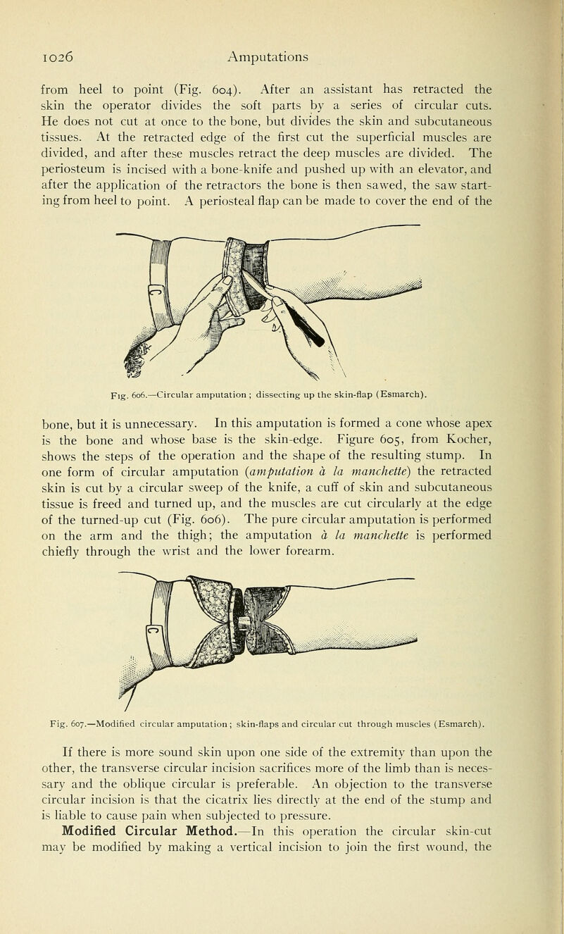 from heel to point (Fig. 604). After an assistant has retracted the skin the operator divides the soft parts by a series of circular cuts. He does not cut at once to the bone, but divides the skin and subcutaneous tissues. At the retracted edge of the first cut the superficial muscles are divided, and after these muscles retract the deep muscles are divided. The periosteum is incised with a bone-knife and pushed up with an elevator, and after the application of the retractors the bone is then sawed, the saw start- ing from heel to point. A periosteal flap can be made to cover the end of the Fig. 606.—Circular amputation ; dissecting up the skin-flap (Esmarch). bone, but it is unnecessary. In this amputation is formed a cone whose apex is the bone and whose base is the skin-edge. Figure 605, from Kocher, shows the steps of the operation and the shape of the resulting stump. In one form of circular amputation {amputation a la manchette) the retracted skin is cut by a circular sweep of the knife, a cuff of skin and subcutaneous tissue is freed and turned up, and the muscles are cut circularly at the edge of the turned-up cut (Fig. 606). The pure circular amputation is performed on the arm and the thigh; the amputation a la manchette is performed chiefly through the wrist and the lower forearm. Fig. 607.—Modified circular amputation ; skin-flaps and circular cut through muscles (Esmarch). If there is more sound skin upon one side of the extremity than upon the other, the transverse circular incision sacrifices more of the limb than is neces- sary and the oblique circular is preferable. An objection to the transverse circular incision is that the cicatrix lies directly at the end of the stump and is liable to cause pain when subjected to pressure. Modified Circular Method.—In this operation the circular skin-cut may be modified by making a vertical incision to join the first wound, the