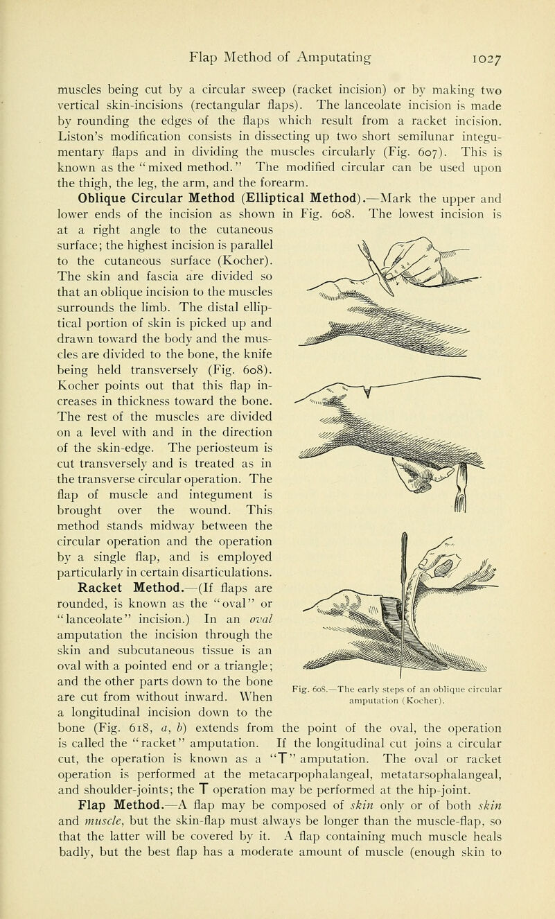 muscles being cut by a circular sweep (racket incision) or by making two vertical skin-incisions (rectangular flaps). The lanceolate incision is made by rounding the edges of the flaps which result from a racket incision. Liston's modification consists in dissecting up two short semilunar integu- mentary flaps and in dividing the muscles circularly (Fig. 607). This is known as the  mixed method. The modified circular can be used upon the thigh, the leg, the arm, and the forearm. Oblique Circular Method (Elliptical Method) .—Mark the upper and lower ends of the incision as shown in Fig. 608. The lowest incision is at a right angle to the cutaneous surface; the highest incision is parallel to the cutaneous surface (Kocher). The skin and fascia are divided so that an oblique incision to the muscles surrounds the limb. The distal ellip- tical portion of skin is picked up and drawn toward the body and the mus- cles are divided to the bone, the knife being held transversely (Fig. 608). Kocher points out that this flap in- creases in thickness toward the bone. The rest of the muscles are divided on a level with and in the direction of the skin-edge. The periosteum is cut transversely and is treated as in the transverse circular operation. The flap of muscle and integument is brought over the wound. This method stands midway between the circular operation and the operation by a single flap, and is employed particularly in certain disarticulations. Racket Method.—(If flaps are rounded, is known as the oval or lanceolate incision.) In an oval amputation the incision through the skin and subcutaneous tissue is an oval with a pointed end or a triangle; and the other parts down to the bone are cut from without inward. When a longitudinal incision down to the bone (Fig. 618, a, b) extends from the point of the oval, the operation is called the racket amputation. If the longitudinal cut joins a circular cut, the operation is known as a T amputation. The oval or racket operation is performed at the metacarpophalangeal, metatarsophalangeal, and shoulder-joints; the T operation may be performed at the hip-joint. Flap Method.—A flap may be composed of skin only or of both skin and muscle, but the skin-flap must always be longer than the muscle-flap, so that the latter will be covered by it. A flap containing much muscle heals badly, but the best flap has a moderate amount of muscle (enough skin to Fig. 608.—The early steps of an oblique circular amputation (Kocher).