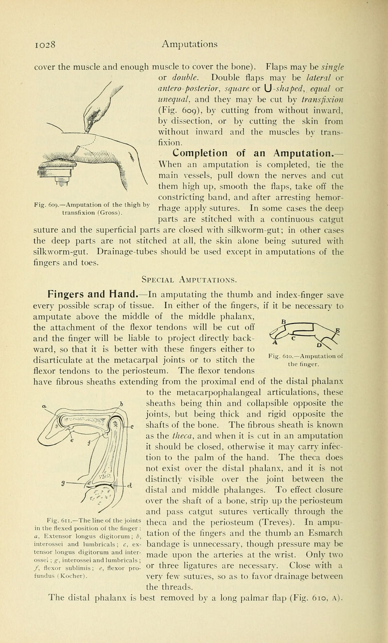 Fig. 609.—Amputation of the thigh by transfixion (Gross). cover the muscle and enough muscle to cover the bone). Flaps may be single or double. Double flaps may be lateral or antero-posterior, square or \J-shaped,, equal or unequal, and they may be cut by transfixion (Fig. 609), by cutting from without inward, by dissection, or by cutting the skin from without inward and the muscles by trans- fixion. Completion of an Amputation.— When an amputation is completed, tie the main vessels, pull down the nerves and cut them high up, smooth the flaps, take off the constricting band, and after arresting hemor- rhage apply sutures. In some cases the deep parts are stitched with a continuous catgut suture and the superficial parts are closed with silkworm-gut; in other cases the deep parts are not stitched at all, the skin alone being sutured with silkworm-gut. Drainage-tubes should be used except in amputations of the fingers and toes. Special Amputations. Fingers and Hand.—In amputating the thumb and index-finger save every possible scrap of tissue. In either of the fingers, if it be necessary to amputate above the middle of the middle phalanx, the attachment of the flexor tendons will be cut off and the finger will be liable to project directly back- ward, so that it is better with these fingers either to disarticulate at the metacarpal joints or to stitch the flexor tendons to the periosteum. The flexor tendons have fibrous sheaths extending from the proximal end of the distal phalanx to the metacarpophalangeal articulations, these sheaths being thin and collapsible opposite the joints, but being thick and rigid opposite the shafts of the bone. The fibrous sheath is known as the theca, and when it is cut in an amputation it should be closed, otherwise it may carry infec- tion to the palm of the hand. The theca does not exist over the distal phalanx, and it is not distinctly visible over the joint between the distal and middle phalanges. To effect closure over the shaft of a bone, strip up the periosteum and pass catgut sutures vertically through the Fig. 611.—The line of the joints t}ieca ancj the periosteum (Treves). In ampu- in the flexed position of the finger • . r . ,, . . . , -,_, . tation of the fingers and the thumb an Fsmarch bandage is unnecessary, though pressure may be made upon the arteries at the wrist. Only two or three ligatures are necessary. Close with a very few sutures, so as to favor drainage between the threads. The distal phalanx is best removed by a long palmar flap (Fig. 610, a). o.—Amputation of the finger. a, Extensor longus digitorum; b, interossei and lumbricals; c, ex- tensor longus digitorum and inter- ossei ; <r, interossei and lumbricals ; f, flexor sublimis ; e, flexor pro- fundus (Kocher).
