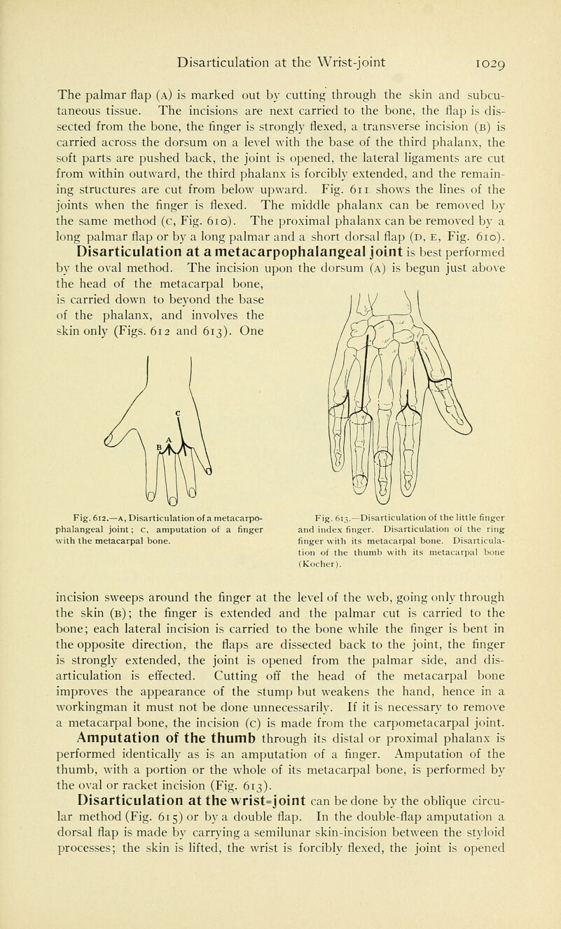 The palmar flap (a) is marked out by cutting through the skin and subcu- taneous tissue. The incisions are next carried to the bone, the flap is dis- sected from the bone, the finger is strongly flexed, a transverse incision (b) is carried across the dorsum on a level with the base of the third phalanx, the soft parts are pushed back, the joint is opened, the lateral ligaments are cut from within outward, the third phalanx is forcibly extended, and the remain- ing structures are cut from below upward. Fig. 611 shows the lines of the joints when the finger is flexed. The middle phalanx can.be removed by the same method (c, Fig. 610). The proximal phalanx can be removed by a long palmar flap or by a long palmar and a short dorsal flap (d, e, Fig. 610). Disarticulation at a metacarpophalangeal joint is best performed by the oval method. The incision upon the dorsum (a) is begun just above the head of the metacarpal bone, is carried down to beyond the base of the phalanx, and involves the skin only (Figs. 612 and 613). One Fig. 612.—a, Disarticulation of a metacarpo- phalangeal joint; c, amputation of a finger with the metacarpal bone. Fig. 613.—Disarticulation of the little finger and index finger. Disarticulation of the ring finger with its metacarpal bone. Disarticula- tion of the thumb with its metacarpal bone (Kocher). incision sweeps around the finger at the level of the web, going only through the skin (b); the finger is extended and the palmar cut is carried to the bone; each lateral incision is carried to the bone while the finger is bent in the opposite direction, the flaps are dissected back to the joint, the finger is strongly extended, the joint is opened from the palmar side, and dis- articulation is effected. Cutting off the head of the metacarpal bone improves the appearance of the stump but weakens the hand, hence in a workingman it must not be done unnecessarily. If it is necessary to remove a metacarpal bone, the incision (c) is made from the carpometacarpal joint. Amputation of the thumb through its distal or proximal phalanx is performed identically as is an amputation of a finger. Amputation of the thumb, with a portion or the whole of its metacarpal bone, is performed by the oval or racket incision (Fig. 613). Disarticulation at the wrist=joint can be done by the oblique circu- lar method (Fig. 615) or by a double flap. In the double-flap amputation a dorsal flap is made by carrying a semilunar skin-incision between the styloid processes; the skin is lifted, the wrist is forcibly flexed, the joint is opened