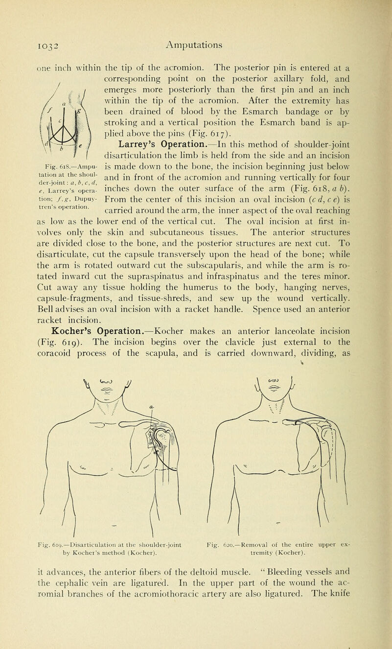one inch within the tip of the acromion. The posterior pin is entered at a corresponding point on the posterior axillary fold, and emerges more posteriorly than the first pin and an inch within the tip of the acromion. After the extremity has been drained of blood by the Esmarch bandage or by stroking and a vertical position the Esmarch band is ap- plied above the pins (Fig. 617). Larrey's Operation.—In this method of shoulder-joint disarticulation the limb is held from the side and an incision is made down to the bone, the incision beginning just below and in front of the acromion and running vertically for four inches down the outer surface of the arm (Fig. 618, a b). From the center of this incision an oval incision (c d, c e) is carried around the arm, the inner aspect of the oval reaching as low as the lower end of the vertical cut. The oval incision at first in- volves only the skin and subcutaneous tissues. The anterior structures are divided close to the bone, and the posterior structures are next cut. To disarticulate, cut the capsule transversely upon the head of the bone; while the arm is rotated outward cut the subscapularis, and while the arm is ro- tated inward cut the supraspinatus and infraspinatus and the teres minor. Cut away any tissue holding the humerus to the body, hanging nerves, capsule-fragments, and tissue-shreds, and sew up the wound vertically. Bell advises an oval incision with a racket handle. Spence used an anterior racket incision. Kocher's Operation.—Kocher makes an anterior lanceolate incision (Fig. 619). The incision begins over the clavicle just external to the coracoid process of the scapula, and is carried downward, dividing, as Fig. 61S.—Ampu- tation at the shoul- der-joint : a, b% c, d% e, Larrey's opera- tion; f,g, Dupuy- tren's operation. Fig. 619.—Disarticulation at the shoulder-joint by Kocher's method (Kocher). Fig. 620.—Removal of the entire upper ex- tremity (Kocher). it advances, the anterior fibers of the deltoid muscle.  Bleeding vessels and the cephalic vein are ligatured. In the upper part of the wound the ac- romial branches of the acromiothoracic artery are also ligatured. The knife