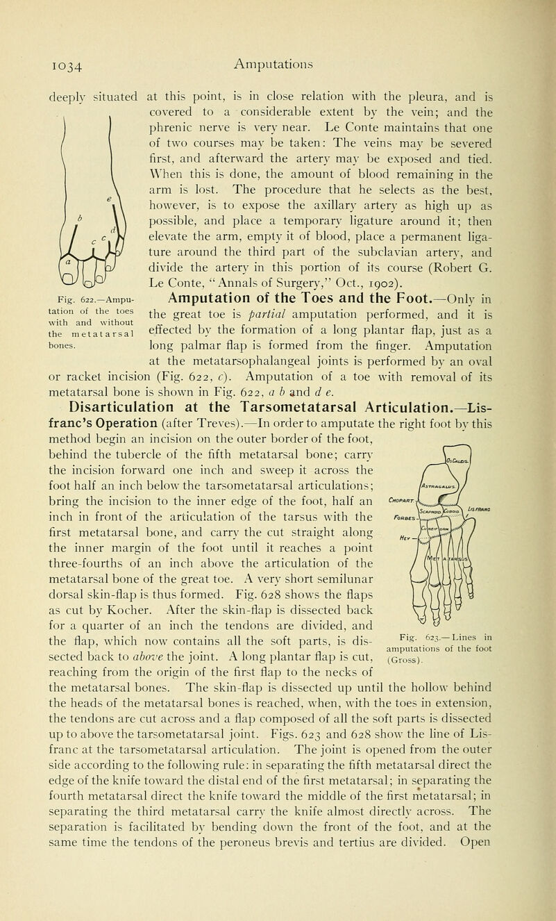 Fig. 622.—Ampu- tation of the toes with and without the metatarsal bones. deeply situated at this point, is in close relation with the pleura, and is covered to a considerable extent by the vein; and the phrenic nerve is very near. Le Conte maintains that one of two courses may be taken: The veins may be severed first, and afterward the artery may be exposed and tied. When this is done, the amount of blood remaining in the arm is lost. The procedure that he selects as the best, however, is to expose the axillary artery as high up as possible, and place a temporary ligature around it; then elevate the arm, empty it of blood, place a permanent liga- ture around the third part of the subclavian artery, and divide the artery in this portion of its course (Robert G. Le Conte, Annals of Surgery, Oct., 1902). Amputation of the Toes and the Foot.—Only in the great toe is partial amputation performed, and it is effected by the formation of a long plantar flap, just as a long palmar flap is formed from the finger. Amputation at the metatarsophalangeal joints is performed by an oval or racket incision (Fig. 622, c). Amputation of a toe with removal of its metatarsal bone is shown in Fig. 622, a b and d e. Disarticulation at the Tarsometatarsal Articulation.—Lis- franc's Operation (after Treves).—In order to amputate the right foot by this method begin an incision on the outer border of the foot, behind the tubercle of the fifth metatarsal bone; carry the incision forward one inch and sweep it across the foot half an inch below the tarsometatarsal articulations; bring the incision to the inner edge of the foot, half an inch in front of the articulation of the tarsus with the first metatarsal bone, and carry the cut straight along the inner margin of the foot until it reaches a point three-fourths of an inch above the articulation of the metatarsal bone of the great toe. A very short semilunar dorsal skin-flap is thus formed. Fig. 628 shows the flaps as cut by Kocher. After the skin-flap is dissected back for a quarter of an inch the tendons are divided, and the flap, which now contains all the soft parts, is dis- sected back to above the joint. A long plantar flap is cut, reaching from the origin of the first flap to the necks of the metatarsal bones. The skin-flap is dissected up until the hollow behind the heads of the metatarsal bones is reached, when, with the toes in extension, the tendons are cut across and a flap composed of all the soft parts is dissected up to above the tarsometatarsal joint. Figs. 623 and 628 show the line of Lis- franc at the tarsometatarsal articulation. The joint is opened from the outer side according to the following rule: in separating the fifth metatarsal direct the edge of the knife toward the distal end of the first metatarsal; in separating the fourth metatarsal direct the knife toward the middle of the first metatarsal; in separating the third metatarsal carry the knife almost directly across. The separation is facilitated by bending down the front of the foot, and at the same time the tendons of the peroneus brevis and tertius are divided. Open Fig. 623.— Lines in amputations of the foot (Gross).