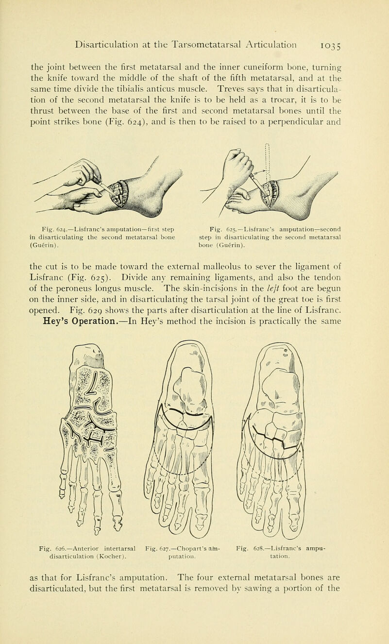 Disarticulation at the Tarsometatarsal Articulation the joint between the first metatarsal and the inner cuneiform bone, turning the knife toward the middle of the shaft of the fifth metatarsal, and at the same time divide the tibialis anticus muscle. Treves says that in disarticula- tion of the second metatarsal the knife is to be held as a trocar, it is to be thrust between the base of the first and second metatarsal bones until the point strikes bone (Fig. 624), and is then to be raised to a perpendicular and Fig. 624.—Lisfranc's amputation—first step in disarticulating the second metatarsal bone (Guerin). Fig. 625.—Lisfranc's amputation—second step in disarticulating the second metatarsal bone (Guerin). the cut is to be made toward the external malleolus to sever the ligament of Lisfranc (Fig. 625). Divide any remaining ligaments, and also the tendon of the peroneus longus muscle. The skin-incisions in the left foot are begun on the inner side, and in disarticulating the tarsal joint of the great toe is first opened. Fig. 629 shows the parts after disarticulation at the line of Lisfranc. Hey's Operation.—In Hey's method the incision is practically the same Fig. 626.—Anterior intertarsal Fig. 627.—Chopart's am- Fig. 628.—Lisfranc's ampu- disarticulation (Kocher). putation. tation. as that for Lisfranc's amputation. The four external metatarsal bones are disarticulated, but the first metatarsal is removed by sawing a portion of the