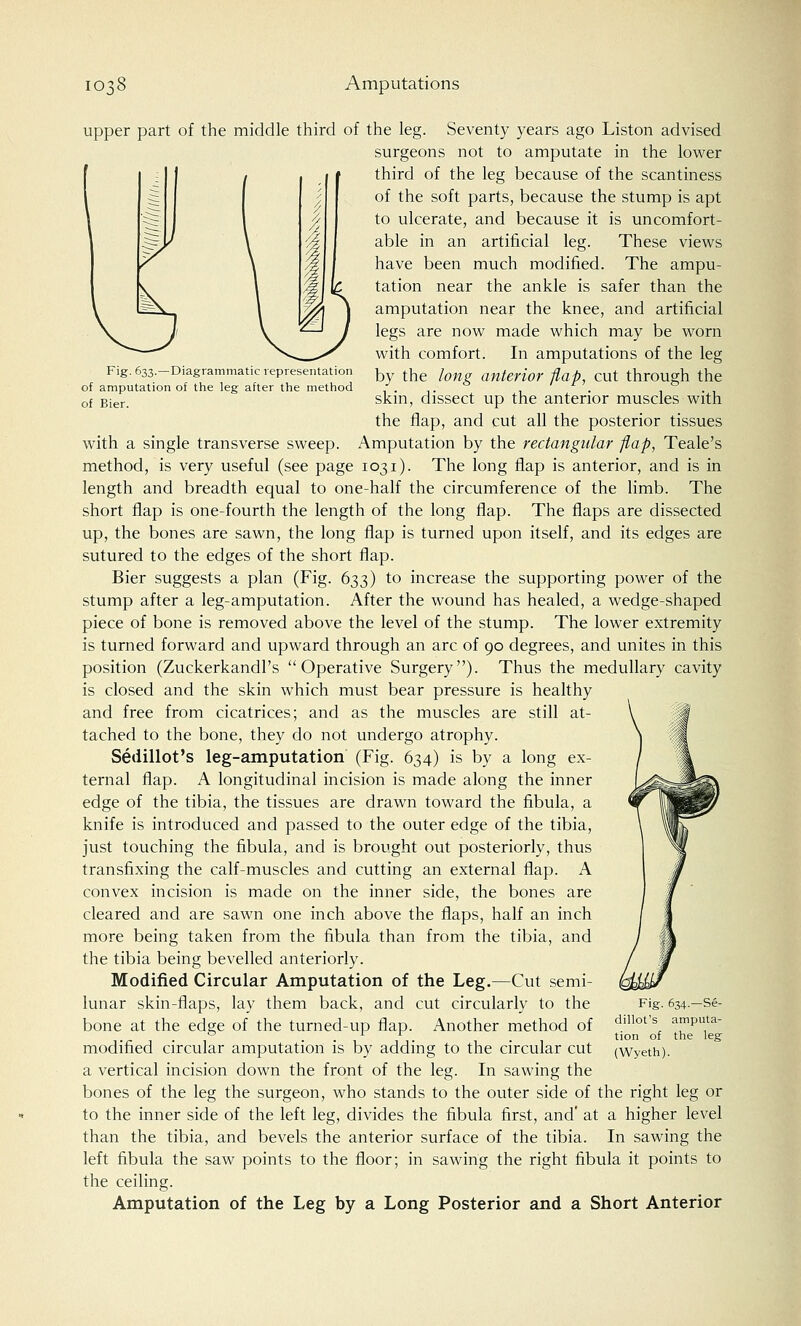 Fig. 633.—Diagrammatic representation of amputation of the leg after the method of Bier. upper part of the middle third of the leg. Seventy years ago Liston advised surgeons not to amputate in the lower third of the leg because of the scantiness of the soft parts, because the stump is apt to ulcerate, and because it is uncomfort- able in an artificial leg. These views have been much modified. The ampu- tation near the ankle is safer than the amputation near the knee, and artificial legs are now made which may be worn with comfort. In amputations of the leg by the long anterior flap, cut through the skin, dissect up the anterior muscles with the flap, and cut all the posterior tissues with a single transverse sweep. Amputation by the rectangular flap, Teale's method, is very useful (see page 1031). The long flap is anterior, and is in length and breadth equal to one-half the circumference of the limb. The short flap is one-fourth the length of the long flap. The flaps are dissected up, the bones are sawn, the long flap is turned upon itself, and its edges are sutured to the edges of the short flap. Bier suggests a plan (Fig. 633) to increase the supporting power of the stump after a leg-amputation. After the wound has healed, a wedge-shaped piece of bone is removed above the level of the stump. The lower extremity is turned forward and upward through an arc of 90 degrees, and unites in this position (Zuckerkandl's Operative Surgery). Thus the medullary cavity is closed and the skin which must bear pressure is healthy and free from cicatrices; and as the muscles are still at- tached to the bone, they do not undergo atrophy. Sedillot's leg-amputation (Fig. 634) is by a long ex- ternal flap. A longitudinal incision is made along the inner edge of the tibia, the tissues are drawn toward the fibula, a knife is introduced and passed to the outer edge of the tibia, just touching the fibula, and is brought out posteriorly, thus transfixing the calf-muscles and cutting an external flap. A convex incision is made on the inner side, the bones are cleared and are sawn one inch above the flaps, half an inch more being taken from the fibula than from the tibia, and the tibia being bevelled anteriorly. Modified Circular Amputation of the Leg.—Cut semi- lunar skin-flaps, lay them back, and cut circularly to the bone at the edge of the turned-up flap. Another method of modified circular amputation is by adding to the circular cut a vertical incision down the front of the leg. In sawing the bones of the leg the surgeon, who stands to the outer side of the right leg or to the inner side of the left leg, divides the fibula first, and' at a higher level than the tibia, and bevels the anterior surface of the tibia. In sawing the left fibula the saw points to the floor; in sawing the right fibula it points to the ceiling. Amputation of the Leg by a Long Posterior and a Short Anterior Fig. 634.—Se- dillot's amputa- tion of the leg (Wyeth).