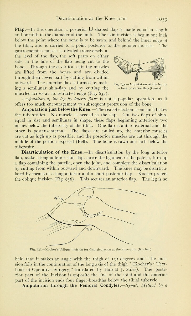 Fig. 635.—Amputation of the leg by a long posterior flap (Gross). Flap.—In this operation a posterior U-shaped flap is made equal in length and breadth to the diameter of the limb. The skin-incision is begun one inch below the point where the bone is to be sawn, and behind the inner edge of the tibia, and is carried to a point posterior to the peronei muscles. The gastrocnemius muscle is divided transversely at the level of the flap, the soft parts on either side in the line of the flap being cut to the bone. Through these vertical cuts the muscles are lifted from the bones and are divided through their lower part by cutting from within outward. The anterior flap is formed by mak- ing a semilunar skin-flap and by cutting the muscles across at its retracted edge (Fig. 635). Amputation of the leg by lateral flaps is not a popular operation, as it offers too much encouragement to subsequent protrusion of the bone. Amputation just below the Knee.—The seat of election is one inch below the tuberosities. No muscle is needed in the flap. Cut two flaps of skin, equal in size and semilunar in shape, these flaps beginning anteriorly two inches below the tuberosity of the tibia. One flap is antero-external and the other is postero-internal. The flaps are pulled up, the anterior muscles are cut as high up as possible, and the posterior muscles are cut through the middle of the portion exposed (Bell). The bone is sawn one inch below the tuberosity. Disarticulation of the Knee.—In disarticulation by the long anterior flap, make a long anterior skin-flap, incise the ligament of the patella, turn up a flap containing the patella, open the joint, and complete the disarticulation by cutting from within outward and downward. The knee may be disarticu- lated by means of a long anterior and a short posterior flap. Kocher prefers the oblique incision (Fig. 636). This secures an anterior flap. The leg is so Fig. 636.—Kocher's oblique incision for disarticulation at the knee-joint (Kocher). held that it makes an angle with the thigh of 135 degrees and the inci- sion falls in the continuation of the long axis of the thigh (Kocher's ''Text- book of Operative Surgery, translated by Harold J. Stiles). The poste- rior part of the incision is opposite the line of the joint and the anterior part of the incision ends four finger-breadths below the tibial tubercle. Amputation through the Femoral Condyles.—Syme's Method by a