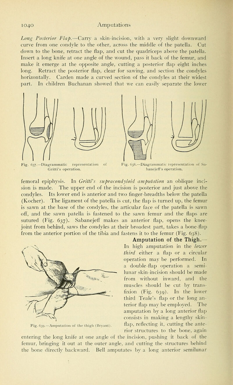 Long Posterior Flap.—Carry a skin-incision, with a very slight downward curve from one condyle to the other, across the middle of the patella. Cut down to the bone, retract the flap, and cut the quadriceps above the patella. Insert a long knife at one angle of the wound, pass it back of the femur, and make it emerge at the opposite angle, cutting a posterior flap eight inches long. Retract the posterior flap, clear for sawing, and section the condyles horizontally. Carden made a curved section of the condyles at their widest part. In children Buchanan showed that we can easily separate the lower Fig. 637.—Diagrammatic representation of Gritti's operation. Fig. 638.—Diagrammatic representation of Sa- banejeff's operation. femoral epiphysis. In Gritti's supracondyloid amputation an oblique inci- sion is made. The upper end of the incision is posterior and just above the condyles. Its lower end is anterior and two finger-breadths below the patella (Kocher). The ligament of the patella is cut, the flap is turned up, the femur is sawn at the base of the condyles, the articular face of the patella is sawn off, and the sawn patella is fastened to the sawn femur and the flaps are sutured (Fig. 637). Sabanejeff makes an anterior flap, opens the knee- joint from behind, saws the condyles at their broadest part, takes a bone-flap from the anterior portion of the tibia and fastens it to the femur (Fig. 638). Amputation of the Thigh.— In high amputation in the lower third either a flap or a circular operation may be performed. In a double-flap operation a semi- lunar skin-incision should be made from without inward, and the muscles should be cut by trans- fixion (Fig. 639). In the lower third Teale's flap or the long an- terior flap may be employed. The amputation by a long anterior flap consists in making a lengthy skin- flap, reflecting it, cutting the ante- rior structures to the bone, again entering the long knife at one angle of the incision, pushing it back of the femur, bringing it out at the outer angle, and cutting the structures behind the bone directly backward. Bell amputates by a long anterior semilunar Fig. 639.—Amputation of the thigh (Bryant).
