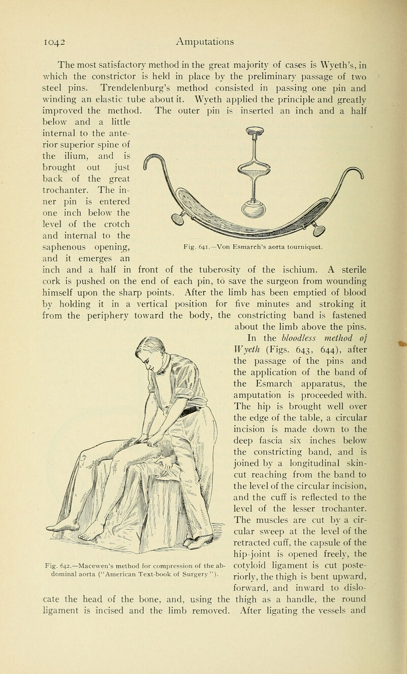 Fig. 641.—Von Esmarch's aorta tourniquet. The most satisfactory method in the great majority of cases is Wyeth's,in which the constrictor is held in place by the preliminary passage of two steel pins. Trendelenburg's method consisted in passing one pin and winding an elastic tube about it. Wyeth applied the principle and greatly improved the method. The outer pin is inserted an inch and a half below and a little internal to the ante- rior superior spine of the ilium, and is brought out just back of the great trochanter. The in- ner pin is entered one inch below the level of the crotch and internal to the saphenous opening, and it emerges an inch and a half in front of the tuberosity of the ischium. A sterile cork is pushed on the end of each pin, to save the surgeon from wounding himself upon the sharp points. After the limb has been emptied of blood by holding it in a vertical position for five minutes and stroking it from the periphery toward the body, the constricting band is fastened about the limb above the pins. In the bloodless method of Wyeth (Figs. 643, 644), after the passage of the pins and the application of the band of the Esmarch apparatus, the amputation is proceeded with. The hip is brought well over the edge of the table, a circular incision is made down to the deep fascia six inches below the constricting band, and is joined by a longitudinal skin- cut reaching from the band to the level of the circular incision, and the cuff is reflected to the level of the lesser trochanter. The muscles are cut by a cir- cular sweep at the level of the retracted cuff, the capsule of the hip-joint is opened freely, the Fig. 642.—Macewen's method for compression of the ab- cotyloid ligament is CUt pOSte- dominal aorta (American Text-book of Surgery ). riorlyj the thigh jg bent upwarcl, forward, and inward to dislo- cate the head of the bone, and, using the thigh as a handle, the round ligament is incised and the limb removed. After ligating the vessels and