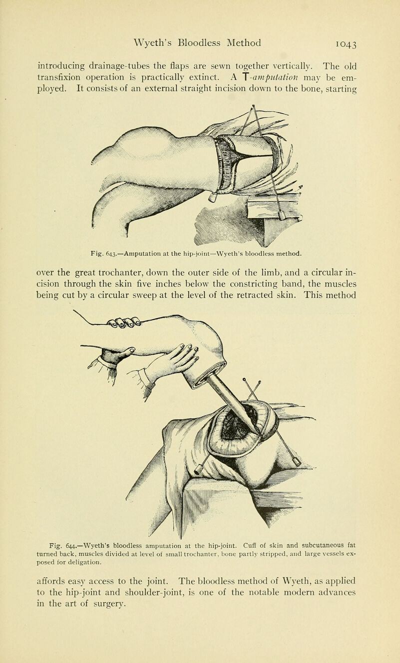 introducing drainage-tubes the flaps are sewn together vertically. The old transfixion operation is practically extinct. A T'-amputation may be em- ployed. It consists of an external straight incision down to the bone, starting Fig. 643.—Amputation at the hip-joint—Wyeth's bloodless method. over the great trochanter, down the outer side of the limb, and a circular in- cision through the skin five inches below the constricting band, the muscles being cut by a circular sweep at the level of the retracted skin. This method Fig. 644.—Wyeth's bloodless amputation at the hip-joint. Cuff of skin and subcutaneous fat turned back, muscles divided at level of small trochanter, bone partly stripped, and large vessels ex- posed for deligation. affords easy access to the joint. The bloodless method of Wyeth, as applied to the hip-joint and shoulder-joint, is one of the notable modern advances in the art of surgery.