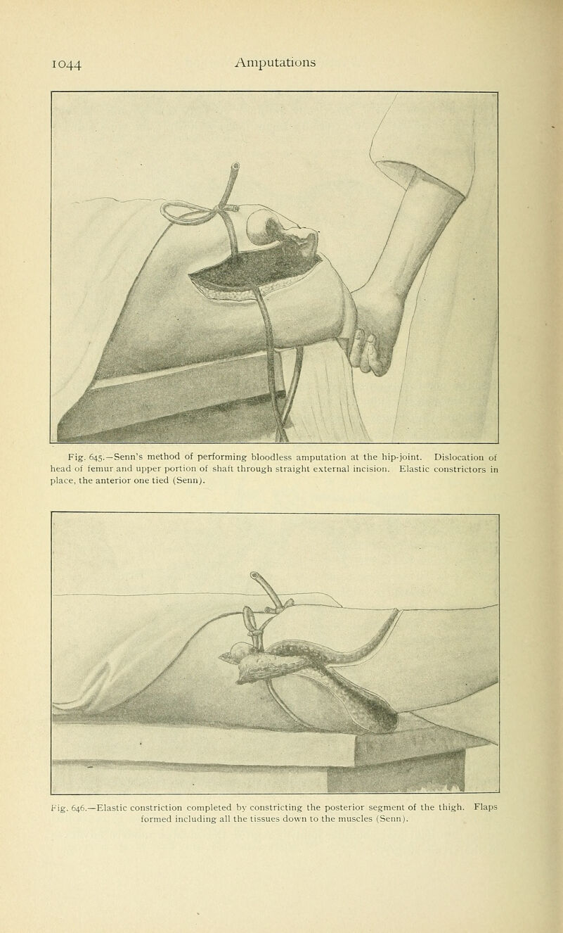 Fig. 645.—Senn's method of performing bloodless amputation at the hip-joint. Dislocation of head of femur and upper portion of shaft through straight external incision. Elastic constrictors in place, the anterior one tied (Sennj. Fig. 646.—Elastic constriction completed by constricting the posterior segment of the thigh. Flaps formed including all the tissues down to the muscles (Senn).