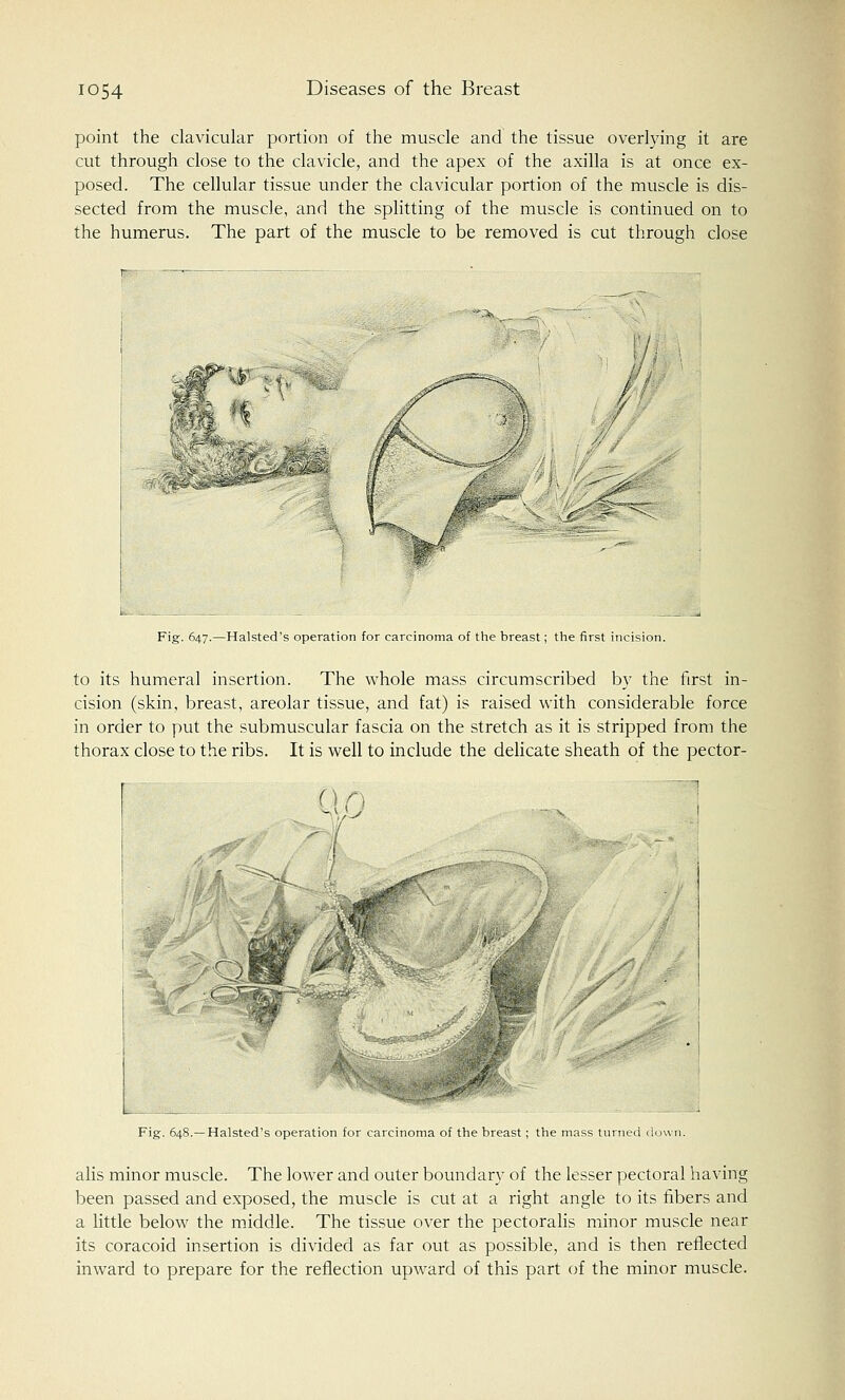 point the clavicular portion of the muscle and the tissue overlying it are cut through close to the clavicle, and the apex of the axilla is at once ex- posed. The cellular tissue under the clavicular portion of the muscle is dis- sected from the muscle, and the splitting of the muscle is continued on to the humerus. The part of the muscle to be removed is cut through close j - --s: 4> W^SS^ d... _ '^\ tf ^> Fig. 647.—Halsted's operation for carcinoma of the breast; the first incision. to its humeral insertion. The whole mass circumscribed by the first in- cision (skin, breast, areolar tissue, and fat) is raised with considerable force in order to put the submuscular fascia on the stretch as it is stripped from the thorax close to the ribs. It is well to include the delicate sheath of the pector- On ] i - Fig. 648.—Halsted's operation for carcinoma of the breast; the mass turned down. alis minor muscle. The lower and outer boundary of the lesser pectoral having been passed and exposed, the muscle is cut at a right angle to its fibers and a little below the middle. The tissue over the pectoralis minor muscle near its coracoid insertion is divided as far out as possible, and is then reflected inward to prepare for the reflection upward of this part of the minor muscle.