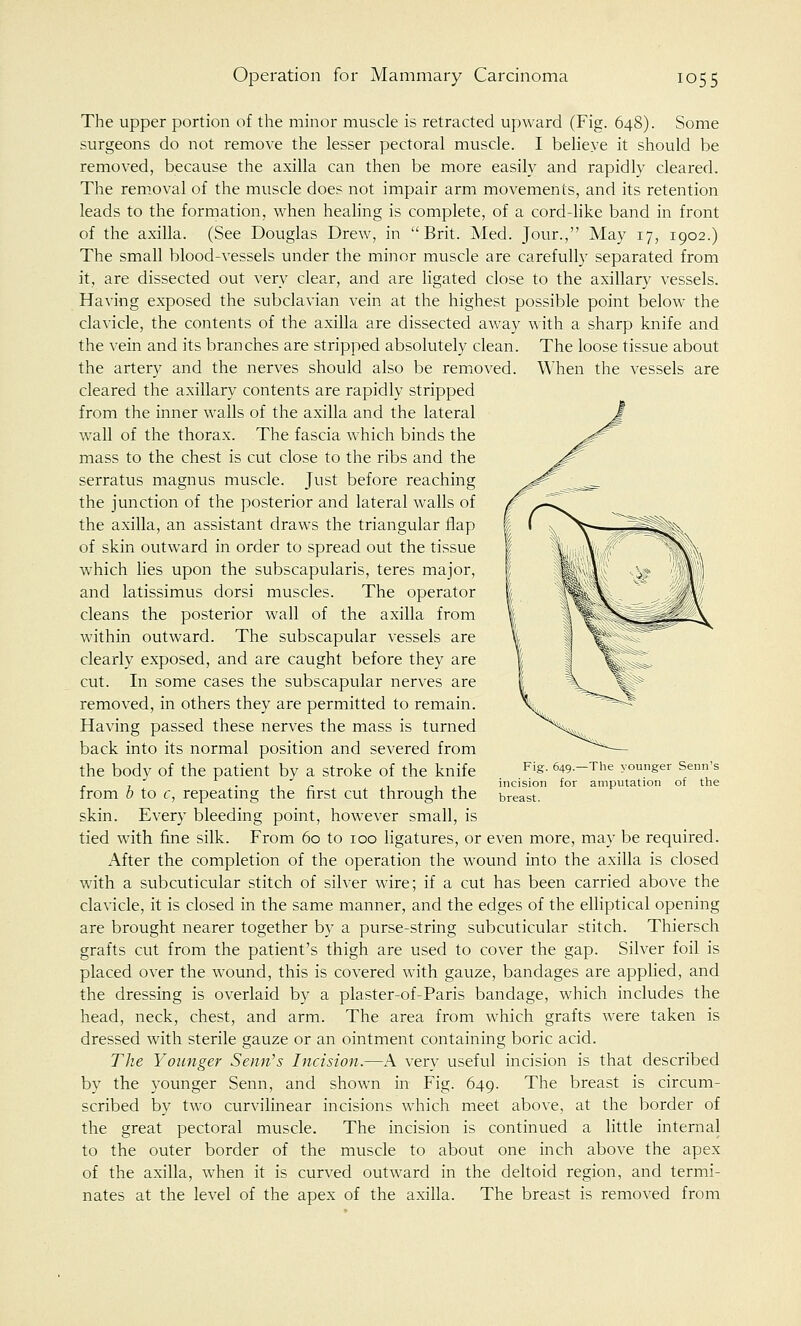 The upper portion of the minor muscle is retracted upward (Fig. 648). Some surgeons do not remove the lesser pectoral muscle. I believe it should be removed, because the axilla can then be more easily and rapidly cleared. The removal of the muscle does not impair arm movements, and its retention leads to the formation, when healing is complete, of a cord-like band in front of the axilla. (See Douglas Drew, in Brit. Med. Jour., May 17, 1902.) The small blood-vessels under the minor muscle are carefully separated from it, are dissected out very clear, and are ligated close to the axillary vessels. Having exposed the subclavian vein at the highest possible point below the clavicle, the contents of the axilla are dissected away with a sharp knife and the vein and its branches are stripped absolutely clean. The loose tissue about the artery and the nerves should also be removed. When the vessels are cleared the axillary contents are rapidly stripped from the inner walls of the axilla and the lateral wall of the thorax. The fascia which binds the mass to the chest is cut close to the ribs and the serratus magnus muscle. Just before reaching the junction of the posterior and lateral walls of the axilla, an assistant draws the triangular flap of skin outward in order to spread out the tissue which lies upon the subscapularis, teres major, and latissimus dorsi muscles. The operator cleans the posterior wall of the axilla from within outward. The subscapular vessels are clearly exposed, and are caught before they are cut. In some cases the subscapular nerves are removed, in others they are permitted to remain. Having passed these nerves the mass is turned back into its normal position and severed from the body of the patient by a stroke of the knife from b to c, repeating the first cut through the skin. Every bleeding point, however small, is tied with fine silk. From 60 to 100 ligatures, or even more, may be required. After the completion of the operation the wound into the axilla is closed with a subcuticular stitch of silver wire; if a cut has been carried above the clavicle, it is closed in the same manner, and the edges of the elliptical opening are brought nearer together by a purse-string subcuticular stitch. Thiersch grafts cut from the patient's thigh are used to cover the gap. Silver foil is placed over the wound, this is covered with gauze, bandages are applied, and the dressing is overlaid by a plaster-of-Paris bandage, which includes the head, neck, chest, and arm. The area from which grafts were taken is dressed with sterile gauze or an ointment containing boric acid. The Younger Semi's Incision.—A very useful incision is that described by the younger Senn, and shown in Fig. 649. The breast is circum- scribed by two curvilinear incisions which meet above, at the border of the great pectoral muscle. The incision is continued a little internal to the outer border of the muscle to about one inch above the apex of the axilla, when it is curved outward in the deltoid region, and termi- nates at the level of the apex of the axilla. The breast is removed from 649.—The younger Senn's incision for amputation of the breast.