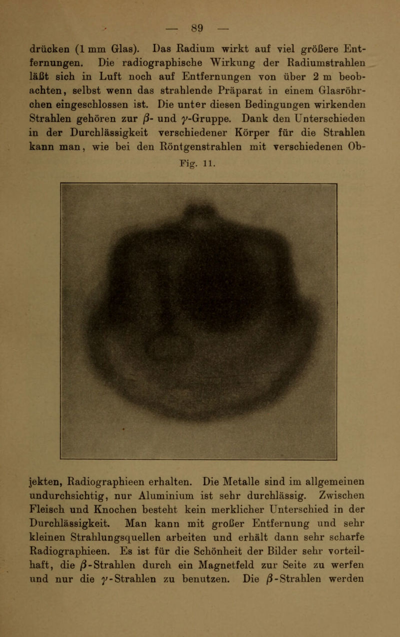 drücken (1 mm Glas). Das Radium wirkt auf viel größere Ent- fernungen. Die radiographische Wirkung der Radiumstrahlen läßt sich in Luft noch auf Entfernungen von über 2 m beob- achten, selbst wenn das strahlende Präparat in einem Glasröhr- chen eingeschlossen ist. Die unter diesen Bedingungen wirkenden Strahlen gehören zur ß- und g^-Gruppe. Dank den Unterschieden in der Durchlässigkeit verschiedener Körper für die Strahlen kann man, wie bei den Röntgenstrahlen mit verschiedenen Ob- Fig. 11. jekten, Radiographieen erhalten. Die Metalle sind im allgemeinen undurchsichtig, nur Aluminium ist sehr durchlässig. Zwischen Fleisch und Knochen besteht kein merklicher Unterschied in der Durchlässigkeit. Man kann mit großer Entfernung und sehr kleinen Strahlungsquellen arbeiten und erhält dann sehr scharfe Radiographieen. Es ist für die Schönheit der Bilder sehr vorteil- haft, die j3-Strahlen durch ein Magnetfeld zur Seite zu werfen und nur die ^^-Strahlen zu benutzen. Die /3-Strahlen werden