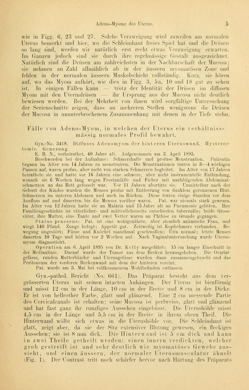 wie in Figg. 6, 23 und 27. Solche Verzweigung wird zuweilen am normalen Uterus bemerkt und hier, wo die Schleimhaut freies Spiel hat und die Drüsen so lang sind, werden wir natürlich erst rechl etwas Verzweigung erwarten. Im Ganzen jedoch sind sie durch ihre regelmässige Gestali ausgezeichnet. Natürlich sind die Drüsen am zahlreichsten in der Nachbarschaft (\<>v .Mucosa; sie nehmen an Zahl allmählich ab in der äussern myomatösen Zone und fehlen in der normalen äussern Muskelschicht vollständig. Kurz, sie hören auf, wo das Myom aufhört, wie dies in Figg. 3, 5a, 10 und 18 gu1 zu sehen ist. In einigen Fällen kann trotz der Identität der Drüsen im diffusen Myom mit den Uterindrüsen ihr Ursprung aus der Mucosa nicht deutlich bewiesen werden. Bei der Mehrheit von ihnen wird sorgfältige Untersuchung der Serienschnitte zeigen, dass an mehreren Stellen wenigstens die Drüsen der Mucosa in ununterbrochenem Zusammenhang mit denen in der Tiefe stehu. Fälle von Adeno-Myom, in welchen der Uterus ein verhältniss- mässig normales Profil bewahrt. Gyn.-No. 3418. Diffuses Adenomyom der hinteren Uteruswand. Hysterec- tomie. Genesung. K. B. N., verheirathet, 40 Jahre alt. Aufgenommen am 3. April 1895. Beschwerden bei der Aufnahme: Schmerzhafte und profuse Menstruation. Patientin begann im Alter von 14 Jahren zu menstruiren. Die Menstruationen traten in 3—4 wöchigen Pausen auf, waren profus, aber nicht von starken Schmerzen begleitet. Im Alter von 17 Jahren heirathete sie und hatte vor 16 Jahren eine schwere, aber nicht instrumenteile Entbindung, wonach sie 6 Wochen lang wegen Frostanfälle und Fieber mit nachfolgenden Abdominal- schmerzen an das Bett gefesselt war. Vor 11 Jahren abortirte sie. Unmittelbar nach der Geburt des Kindes wurden die Menses profus mit Entleerung von dunklem geronnenen Blut. Schmerzen im unteren Abdomen und auch im Rücken. Diese traten einige Stunden vor dem Ausfluss auf und dauerten bis die Menses vorüber waren. Pat. war niemals stark gewesen. Im Alter von 12 Jahren hatte sie an Malaria und 15 Jahre alt an Pneumonie gelitten. Ihre Familiengeschichte ist väterlicher- und mütterlicherseits entschieden tuberculös; beide Gross- väter, ihre Mutter, eine Tante und zwei Vetter waren an Phthise zu Grunde gegangen. Status praesens: Pat. ist eine wohlgenährte, aber ziemlich anämische Frau, und wiegt 140 Pfund. Zunge belegt; Appetit gut. Zeitweilig ist Kopfschmerz vorhanden. Be- wegung ungestört; Füsse und Knöchel manchmal geschwollen: Urin normal: letzte Menses dauerten 10 Tage und hörten vor 2 Wochen auf. Nach Vaginaluntersuchung wurde Uterus- myom diagnosticirt. Operation am 6. April 1895 von Dr. Kelly ausgeführt: 15 cm langer Einschnitt in der Medianlinie. Darauf wurde der Tumor aus dem Becken herausgehoben. Die Ovarial- gefässe, runden Mutterbänder und Uterusgefässe wurden dann zusammengebracht und das Peritoneum der vorderen Beckenwand mit dem der hinteren vereint. Pat. wurde am 3. Mai bei vollkommenem Wohlbefinden entlassen. Gyn.-pathol. Bericht (No. 661). Das Präparat besteht aus dem ver- grösserten Uterus mit seinen intacten Anhängen. Der Uterus ist birnförmig und misst 12 cm in der Länge, 10 cm in der Breite und 8 cm in der Dicke. Er ist von hellrother Farbe, glatt und glänzend. Eine 2 cm messende Partie des Cervicalcanals ist erhalten; seine Mucosa ist periweiss, glatt und glänzend und hat fast ganz ihr runzliges Aussehen eingebüsst. Die Uterushöhle misst 4,5 cm in der Länge und 5,5 cm in der Breite in ihrem obern Theil. Die Hinterwand wölbt sich etwas in die Uterushöhle vor. Die Schleimhaut ist glatt, zeigt aber, da sie der Sitz extensiver Blutung gewesen, ein fleckiges xlussehen; sie ist 8 mm dick. Die Hinterwand ist 5 cm dick und kann in zwei Theile getheilt werden: einen innern verdickten, welcher grob gestreift ist und sehr deutlich wie myomatöses Gewebe aus- sieht, und einen äussern, der normaler Uterusmusculatur ähnelt (Fig. 1). Der Contrast tritt noch schärfer hervor nach Härtung des Präparats