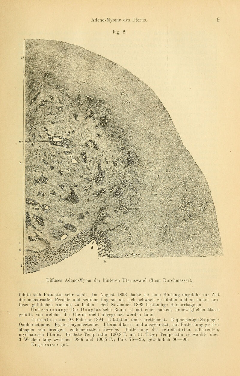 Fig. 2. >^M&k. m \ - ><::.~. Diffuses Adeno-Myom der hinteren Uteruswand (3 cm Durchmesser). fühlte sich Patientin sehr wohl. Im August 1893 hatte sie eine Blutung ungefähr zur Zeit der menstrualen Periode und seitdem fing sie an, sich schwach zu fühlen und an einem pro- fusen gelblichen Ausfluss zu leiden.' Seit November 1893 beständige Hämorrhagieen. Untersuchung: Der Douglas'sche Raum ist mit einer harten, unbeweglichen Masse gefüllt, von welcher der Uterus nicht abgegrenzt werden kann. Operation am 10. Februar 1894. Dilatation und Curettement. Doppelseitige Salpingo- Oophorectomie. Hysteromyomectomie. Uterus dilatirt und ausgekratzt, mit Entfernung grosser Mengen von breiigem endometrialem Gewebe. Entfernung des retroflectirten, adhärenten, myomatösen Uterus. Höchste Temperatur 100,8 F. am 11. Tage; Temperatur sehwankte über 3 Wochen lang zwischen 98,6 und 100,5 F.; Puls 76—9G, gewöhnlich 80-90. Ergebniss: gut.