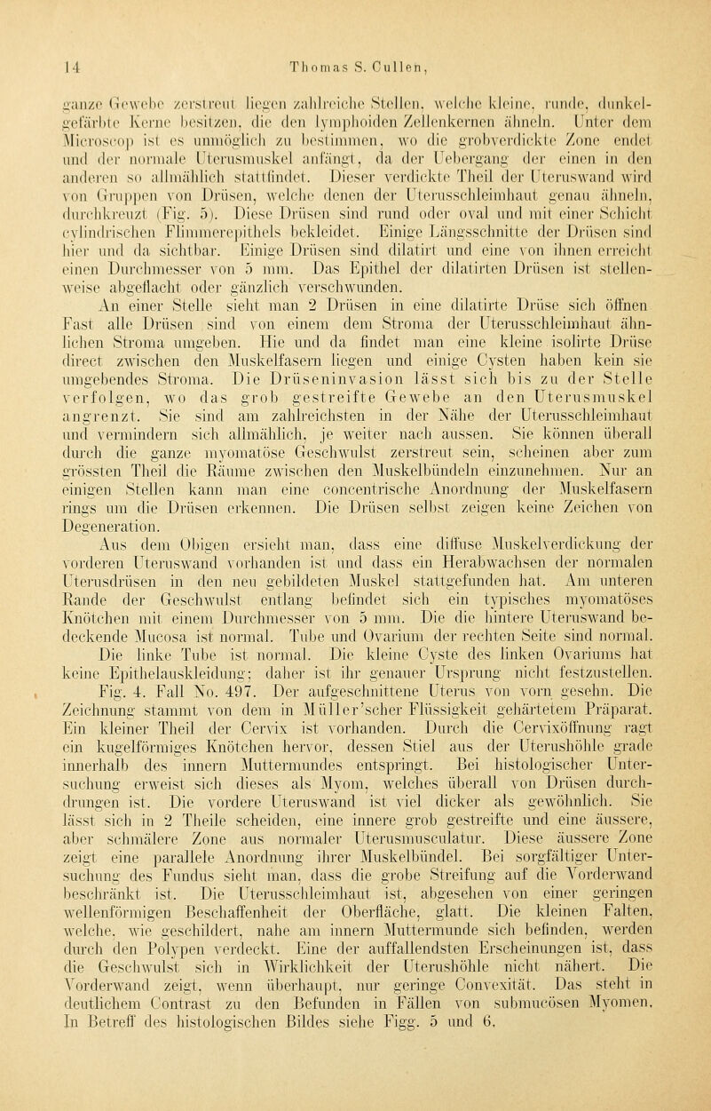 ganze Gewebe zerstreul liegen zahlreiche Stellen, welche kleine rande, dunkel- gefärbte Kerne besitzen, die den Iyinplioiden Zellenkernen ähneln. Unter dem Microseop ist es unmöglich zu bestimmen, wo die grobverdickte Zone endet und der normale Uterusmuskcl anlangt, da der Uebergang i\rv einen in den anderen so allmählich stattfindet. Dieser verdickte Theil der Uteruswand wird von Gruppen von Drüsen, welche denen der Uterusschleimhaut genau ähneln, durchkreuzt (Fig. 5). Diese Drüsen sind rund oder oval und mit einer Schicht ey Lim Irischen Flimmerepithels bekleidet, Einige Längsschnitte der Drüsen sind hier und da sichtbar. Einige Drüsen sind dilatirt und eine von ihnen erreichl einen Durchmesser von 5 mm. Das Epithel der dilatirten Drüsen ist stellen- weise abgeflacht oder gänzlich verschwunden. An einer Stelle sieht man 2 Drüsen in eine dilatirte Drüse sich öffnen Fast alle Drüsen sind von einem dem Stroma der Uterusschleimhaut ähn- lichen Stroma umgeben. Hie und da findet man eine kleine isolirte Drüse direct zwischen den Muskelfasern liegen und einige Cysten haben kein sie umgebendes Stroma. Die Drüseninvasion lässt sich bis zu der Stelle verfolgen, wo das grob gestreifte Gewebe an den Uterusmuskel angrenzt. Sie sind am zahlreichsten in der Nähe der Uterusschleimhaut und vermindern sich allmählich, je weiter nach aussen. Sie können überall durch die ganze myomatöse Geschwulst zerstreut sein, scheinen aber zum grössten Theil die Räume zwischen den Muskelbündeln einzunehmen. Nur an einigen Stellen kann man eine concentrische Anordnung der Muskelfasern rings um die Drüsen erkennen. Die Drüsen selbst zeigen keine Zeichen von Degeneration. Aus dem Obigen ersieht man, class eine diffuse Muskelverdickimg der vorderen Uteruswand vorhanden ist und dass ein Herab wachsen der normalen Uterusdrüsen in den neu gebildeten Muskel stattgefunden hat, Am unteren Rande der Geschwulst entlang befindet sich ein typisches myomatöses Knötchen mit einem Durchmesser von 5 mm. Die die hintere Uteruswand be- deckende Muoosa ist normal. Tube und Ovarium der rechten Seite sind normal. Die linke Tube ist normal. Die kleine Cyste des linken Ovariums hat keine Epithelauskleidung; daher ist ihr genauer Ursprung nicht festzustellen. Fig. 4. Fall No. 497. Der aufgeschnittene Uterus von vorn gesehn. Die Zeichnung stammt von dem in Müller'scher Flüssigkeit gehärtetem Präparat. Ein kleiner Theil der Oervix ist vorhanden. Durch die Cervixöffnung ragt ein kugelförmiges Knötchen hervor, dessen Stiel aus der Uterushöhle grade innerhalb des innern Muttermundes entspringt. Bei histologischer Unter- suchung erweist sich dieses als Myom, welches überall von Drüsen durch- drungen ist. Die vordere Uteruswand ist viel dicker als gewöhnlich. Sie lässt sich in 2 Theile scheiden, eine innere grob gestreifte und eine äussere, aber schmälere Zone aus normaler Uterusmusculatur. Diese äussere Zone zeigt eine parallele Anordnung ihrer Muskelbündel. Bei sorgfältiger Unter- suchung des Fundus sieht man, dass die grobe Streifung auf die Vorderwand beschränkt ist. Die Uterusschleimhaut ist, abgesehen von einer geringen wellenförmigen Beschaffenheit der Oberfläche, glatt. Die kleinen Falten, welche, wie geschildert, nahe am innern Muttermunde sich befinden, werden durch den Polypen verdeckt. Eine der auffallendsten Erscheinungen ist, dass die Geschwulst sich in Wirklichkeit der Uterushöhle nicht nähert, Die Vorderwand zeigt, wenn überhaupt, nur geringe Convexität, Das stellt in deutlichem Contrast zu den Befunden in Fällen von submueösen Myomen.