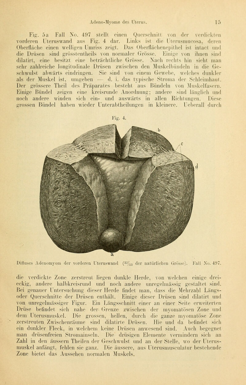 Fig. 5a Fall No. 497 stellt einen Querschnitt von <I<t verdickten vorderen [Jteruswand ans Fig. 4 dar. Links is! die Uterusmucosa, deren Oberfläche einen welligen Umriss zeigt, Das Oberflächenepithel ist intacl und die Drüsen sind grösstentheils von normaler Grösse. Einige von ihnen sind dilatirt, eine besitzt eine beträchtliche Grösse. Nach rechts hin sieht man sehr zahlreiche longitudinale Drüsen zwischen den Muskelbündeln in die Ge- schwulst abwärts eindringen. Sie sind von einem Gewebe, welches dunkler als der Muskel ist, umgeben — d. i. das typische Stroma t\cv Schleimhaut. Der grössere Theil des Präparates besteht aus Bündeln von .Muskelfasern. Einige Bündel zeigen eine kreisrunde Anordnung; andere sind länglich und noch andere winden sich ein- und auswärts in allen Richtungen. Diese grossen Bündel haben wieder Unterabtheilungen in kleinere. Ueberall durch ä Diffuses Adenomyom der vorderen Uteruswand (12/13 der natürlichen Grösse). Fall No. 497. die verdickte Zone zerstreut liegen dunkle Herde, von welchen einige drei- eckig, andere halbkreisrund und noch andere unregelmässig gestaltet sind. Bei genauer Untersuchung dieser Herde findet man, dass die Mehrzahl Längs- oder Querschnitte der Drüsen enthält. Einige dieser Drüsen sind dilatirt und von unregelmässiger Figur. Ein Längsschnitt einer an einer Seite erweiterten Drüse befindet sich nahe der. Grenze zwischen der myomatösen Zone und dem Uterusmuskel. Die grossen, hellen, durch die ganze myomatöse Zone zerstreuten Zwischenräume sind dilatirte Drüsen. Hie und da befindet sich ein dunkler Fleck, in welchem keine Drüsen anwesend sind. Auch begegnet man drüsenfreien Stromainseln. Die' drüsigen Elemente vermindern sich an Zahl in den äussern Theilen der Geschwulst und an der Stelle, wo der Uterus- muskel anfängt, fehlen sie ganz. Die äussere, aus Uterusmusculatur bestehende Zone bietet das Aussehen normalen Muskels,