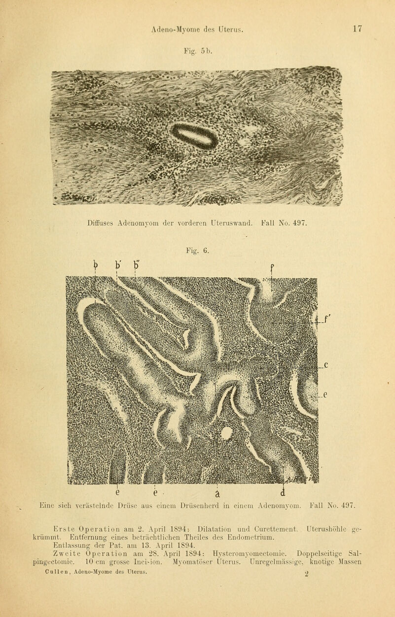 Fig. 5b. -^-- — rzi-zö • .#^£fcfc£ Diffuses Adenomvom der vorderen Uteruswand. Fall No. 497. Fig. 6. V V t> e i i Eine sich verästelnde Drüse aus einem Drüsenherd in einem Adenomyom. Fall No. 497. Erste Operation am 2. April 1894j Dilatation und Curettement. Uterushöhle ge- krümmt. Entfernung eines beträchtlichen Theiles des Endometrium. Entlassung der Pat. am 13. April 1894. Zweite Operation am 28. April 1894: Hysteromyornectomie. Doppelseitige Sal- pingektomie. 10 cm grosse Inci.-ion. Myomatöser Uterus. Unregelmässige, knotige Massen Cullen, Adeno-Myome des Uterus. g