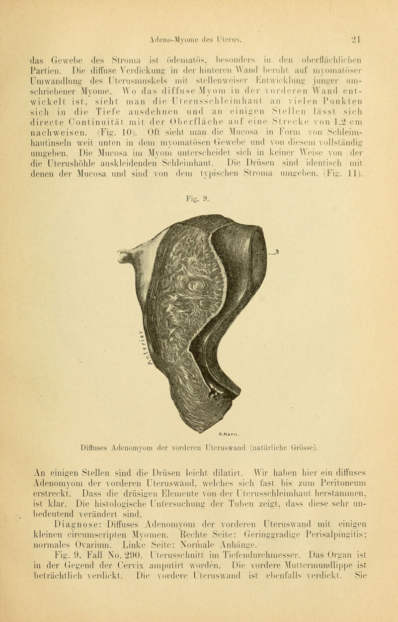 das Gewebe des Stroma isi ödcmatös, besonders in den oberflächlichen Partien. Die diffuse Verdickung in der hinteren Wand beruhl auf myomatöser Umwandlung des Uterusmuskels inii stellenweiser Entwicklung junger um- schriebener Myome., Wo das diffuse Myom in der vorderen Wand ent- wickelt ist, sieh! man die Uterusschleimhaul an vielen Punkten sich in die Tiefe ausdehnen und an einigen Si eilen lässl sich directe Oontinuität mit der Oberfläche auf eine Strecke von 1,2cm nachweisen. (Fig. 10). Oft sieht man die Mucosa in Form von Schleim- hautinseln weit unten in dem myomatösen Gewebe and von diesem vollständig umgeben. Die Mucosa im Myom unterscheidet sieb in keiner Weise von der die Uteroshöhle auskleidenden Sehleimhaut. Die Drüsen sind identisch mir denen der Mucosa und sind von dem typischen Stroma umgeben. (Fig. llj. Pia;, 9. Diffuses Adenomyom der vorderen Uteruswand (natürliche Grösse). An einigen Stellen sind die Drüsen leicht dilatirt. Wir haben liier ein diffuses Adenomyom der vorderen Uteraswand, welches sich fast bis zum Peritoneum erstreckt. Dass die drüsigen Elemente von der Uterusschleimhaut herstammen, ist klar. Die histologische Untersuchung der Tuben zeigt, dass diese sehr un- bedeutend verändert sind. Diagnose: Diffuses Adenomyom der vorderen Uteruswand mit einigen kleinen circumscripten Myomen. Rechte Seite: Geringgradige Perisalpingitis: normales Ovarium. Linke Seite: Normale Anhänge. Fig. 9. Fall No. 290. Uterusschnitt im Tiefendurchmesser. Das Organ ist in der Gegend der Oervix amputirt worden. Die vordere Muttermundlippe ist beträchtlich verdickt. Die vordere üteruswand ist ebenfalls verdickt. Sie