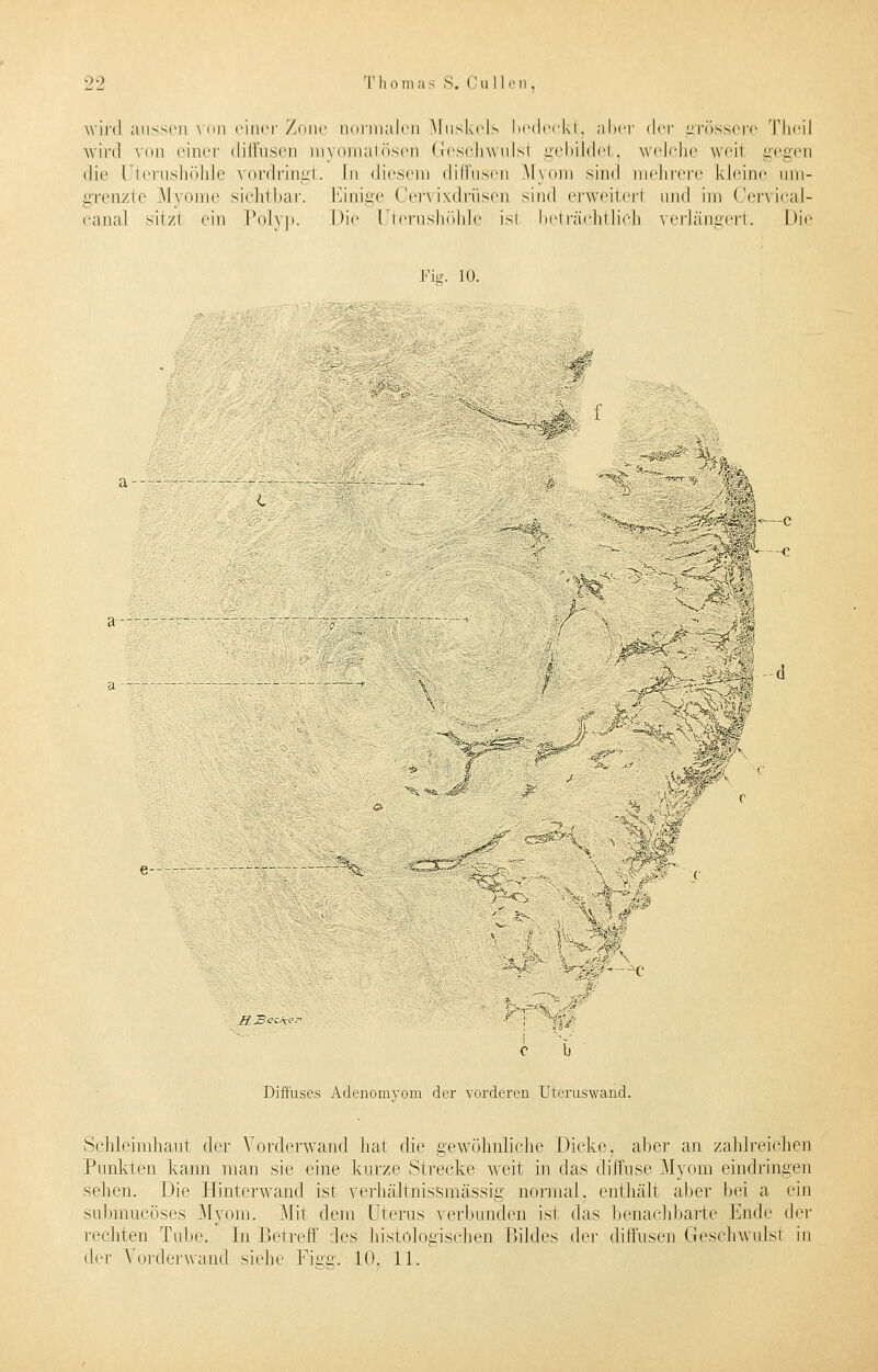 22 T h o m a s S. Cull er , wird aussen von einer Zone normalen Muskels bedeckt, aber <\rv grössere TheiJ wird von einer diffusen rayomatösen Geschwulsl gebildet, welche weil gegen die (Jterushöhle vordringt. In diesem diffusen Myom sind mehrere kleine um- grenzte Myome sichtbar. Einige Cervixdrüsen sind erweitert und im Cervical- canal sitzt ein Polyp. Die [Jterushöhle isl beträchtlich verlängert. Die Für. 10. ■• i- •' . c % cs-r-'V.'.. - - ,: '%5; . - '-. mW. c b Diffuses Adenomyom der vorderen Uteruswand. Schleimhaut der Vorderwand hat die gewöhnliche Dicke, aber an zahlreichen Punkten kann man sie eine kurze Strecke weit in das diffuse Myom eindringen sehen. Die Hinterwand ist verhältnissmässig normal, enthält alier bei a ein submueöses Myom. Mit dem Uterus verbunden ist das benachbarte Ende der rechten Tube. In Betreff des histologischen Bildes der diffusen Greschwulsl in