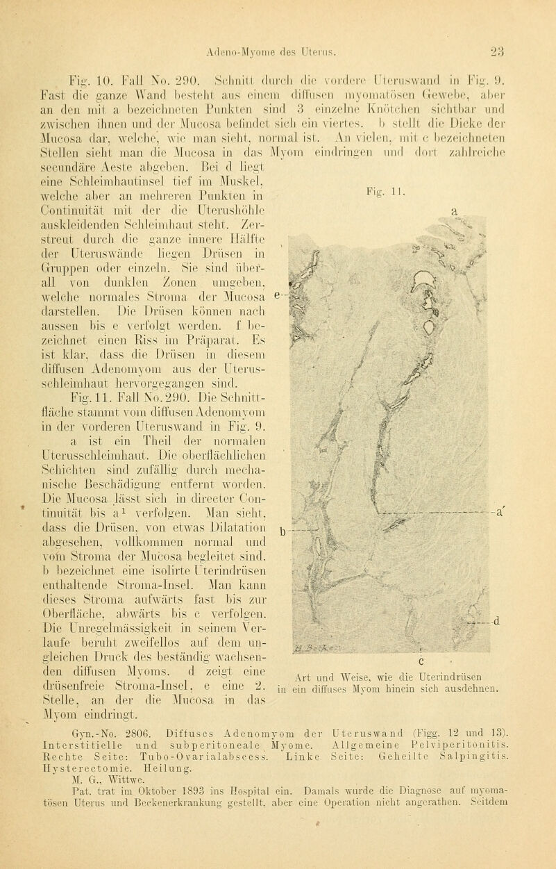 Fig. 10. Fall No. 290. Schnitl durch die vordere Uteruswand in Fig. 9. Fast die ganze Wand besteh! ans einem diffusen my atösen Gewebe, aber an den mit a bezeichneten Punkten sind 3 einzelne Knötchen sichtbar und zwischen ihnen und der Mucosa befindel sich ein viertes. I» stelll die Dicke <]ev Mucosa dar, welche, wie man sieht, normal isi. An \ielcn. mii c bezeichneten Stellen sieht man die Mucosa in das Myom eindringen \\\\<\ dorl zahlreiche seeundäre Aeste abgeben. Bei d Lieg! eine Schleimhautinsel tief im Muskel, welche aber an mehreren Punkten in Fl§- 11- Continuität mit der die Uterushöhle a auskleidenden Schleimhaut steht. Zer- streut durch die ganze innere Hälfte der Uteruswände liegen Drüsen in ,:? V' Gruppen oder einzeln. Sie sind über- & all von dunklen Zonen umgelten, *sj /'-'• welche normales Stroma der Mucosa e~~§v^ ' fk darstellen. Die Drüsen können nach ' g v'1§ aussen bis e verfolgt werden, f be- zeichnet einen Riss im Präparat. Es ^ ist klar, dass die Drüsen in diesem - m diffusen Adenomyom aus der Uterus- ' ip Schleimhaut hervorgegangen sind. ** Fig. 11. Fall No. 290. Die Schnitt- M fläche stammt vom diffusen Adenomyom in der vorderen Uteruswand in Fig. 9. a ist ein Theil der normalen 11 Uterusschleimhaut. Die oberflächlichen Schichten sind zufällig durch mecha- nische Beschädigung entfernt worden. Die Mucosa lässt sich in directer Con- ', tinuität bis a1 verfolgen. Man sieht. —-~ — a' dass die Drüsen, von etwas Dilatation ^1 -^ abgesehen, vollkommen normal und vom Stroma der Mucosa begleitet sind, b bezeichnet eine isolirte Uterindrüsen enthaltende Stroma-Insel. Man kann dieses Stroma aufwärts fast bis zur Oberfläche, abwärts bis c verfolgen. -, Die Unregelmässigkeit in seinem Ver- laufe beruht zweifellos auf dem im- v * ,v- gleichen Druck des beständig wachsen- \ den diffusen Myoms, d zeigt eine ^ und w^ wie ^ uterindrüsen dmsenireie Stroma-Insel, e eine 2. in ein diffuses Myom hinein sich ausdehnen. Stelle, an der die Mucosa in das Myom eindringt. Gyn.-No. 2806. Diffuses Adenomyom der Uteruswand (Figg. 12 und 13). Interstitielle und subp eritoneale v Myome. Aligemeine Petviperitonitis. Rechte Seite: Tubo-0 var ialabscess. Linke Seite: Geheilte Salpingitis. Hysterectomie. Heilung. M. G., Wittwe. Pat. trat im Oktober 1893 ins Hospital ein. Damals wurde die Diagnose auf myoma- tösen Uterus und Beckenerkrankung gestellt, aber eine Operation nicht angerathen. Seitdem