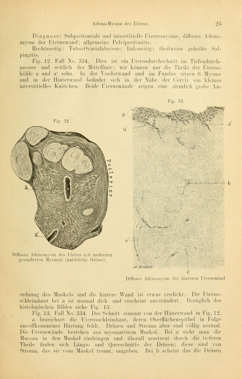 Diagnose: Subperitoneale und interstitielle Uterusmyome, diffuses Adeno- myom der Uteruswand; allgemeine Pelviperitonitis. Rechtsseitig: Tubo-Ovarialabscess; linksseitig: theilweise geheilte Sal- pingitis. Fig. 12. Fall No. 334. Dies ist ein Uterusdurchschnitl im Tiefendurch- messer und seitlich der Mittellinie; wir können nur die Theile der Uterus- höhle a und a' sehn. In der Vorderwand und im Fundus sitzen 6 Myome und in der Hinterwand befindet sich in (\<ir Nähe der Oervix ein kleines interstitielles Knötchen. Beide UterusWände zeigen eine ziemlich grobe \n- Fie;. 13. Fig. 12. a Diffuses Adenomyom des Uterus mit mehreren gesonderten Myomen (natürliche Grösse). *Sf:'JBec&.er; Diffuses Adenomyom der hinteren Uteruswand Ordnung des Muskels und die hintere Wand ist etwas verdickt. Die Uterus- schleimhaut bei a ist normal dick und erscheint unverändert. Bezüglich des histologischen Bildes siehe Fig.' 13. Fig. 13. Fall No. 334. Der Schnitt stammt von der Hinterwand in Fig. 12. a bezeichnet die Uterusschleimhaut, deren Oberflächenepithel in Folge unvollkommener Härtung fehlt. Drüsen und Stroma aber sind völlig normal. Die Uteruswände bestehen aus myomatösem Muskel. Bei a' sieht man die Mucosa in den Muskel eindringen und überall zerstreut durch die tieferen Theile linden sich Längs- und Querschnitte der Drüsen: diese sind von Stroma, das sie vom Muskel trennt, umgeben. Bei b scheint das die Drüsen
