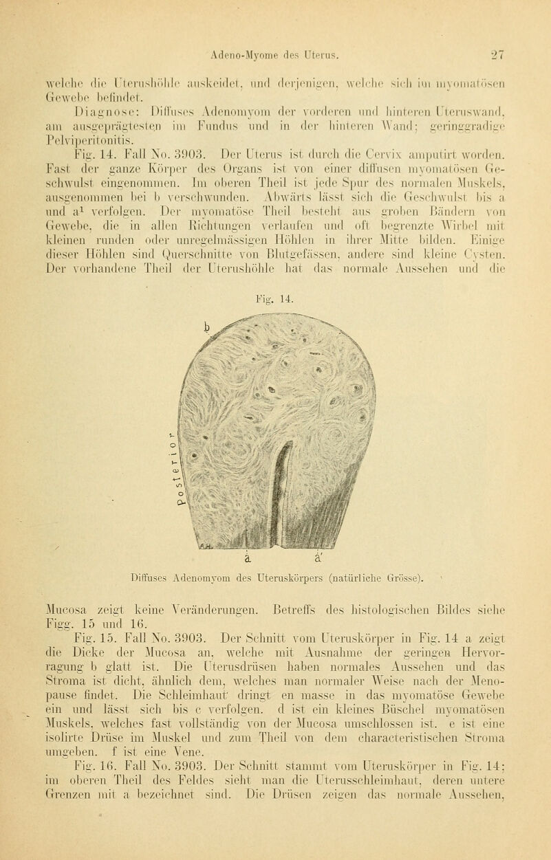 welche die l terushöhlc auskeidet, und derjenigen, welche sich iui myomatösen Gewebe befindet. Diagnose: Diffuses Adenomyom der vorderen und liinteren I temswand, am ausgeprägtesten im Fundus und in der hinteren Wand: geringgradige Pelviperitonitis. Fig. 14. Fall No. 3903. Der Uterus ist durch die Cervix amputiri wurden. Fast der ganze Körper des Organs ist von einer diffusen myomatösen Ge- schwulst eingenommen. Im oberen Theil ist jede Spur des normalen Muskels. ausgenommen bei b verschwunden. Abwärts Jässt sieh die Geschwulst bis a und a1 verfolgen. Der myomatöse Theil bestehl aus groben Bänden) von Gewebe, die in allen Richtungen verlaufen und oft begrenzte Wirbel mit kleinen runden oder unregelmässigen Höhlen in ihrer Mitte bilden. Einige dieser Höhlen sind Querschnitte von Blutgefässen, andere sind kleine Cysten. Der vorhandene Theil der Uterushöhle hat das normale Aussehen und die Fie. 14. AM*?. Diffuses Adenomyom des Uteruskörpers (natürliche Grösse). Mucosa zeigt keine Veränderungen. Betreffs des histologischen Bildes siehe Figg. 15 und 16. Fig. 15. Fall No. 3903. Der Schnitt vom Uteruskörper in Fig. 14 a zeigt die Dicke der Mucosa an, welche mit Ausnahme der geringen Hervor- ragung b glatt ist. Die Uterusdrüsen haben normales Aussehen und das Stroma ist dicht, ähnlich dem, welches man normaler Weise nach der .Meno- pause findet. Die Schleimhaut dringt en masse in das myomatöse Gewebe ein und lässt sich bis c verfolgen, d ist ein kleines Büschel myomatösen Muskels, welches fast vollständig von der Mucosa umschlossen ist. e ist eine isolirte Drüse im Muskel und zum Theil von dem characteristischen Stroma f ist eine Vene. Fig. 16. Fall No. 3903. Der Schnitt stammt vom Uteraskörper in Fig. 14; im oberen Theil des Feldes sieht man die Uterusschleimhaut, deren untere Grenzen mit a bezeichnet sind. Die Drüsen zeigen das normale Aussehen. umgeben
