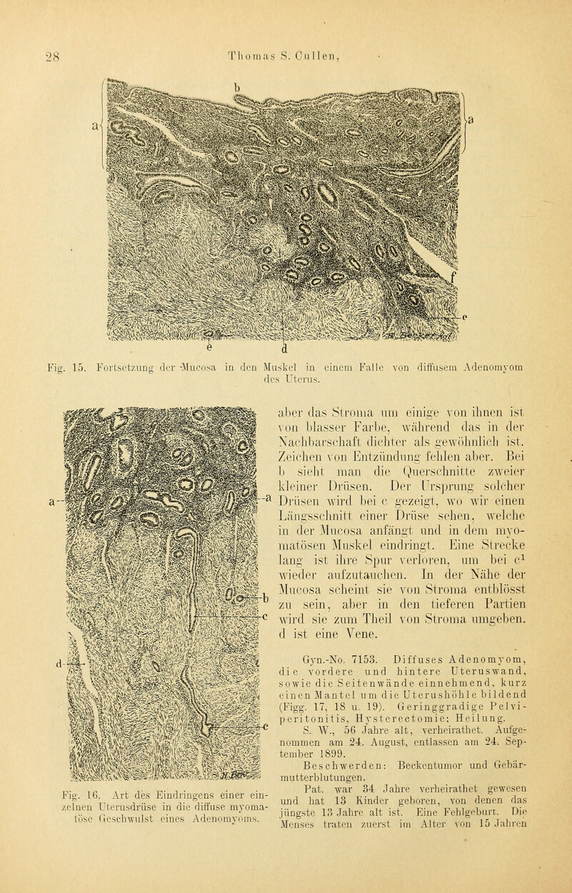 -*&>* «,,„ .v: f Fig. 15. Fortsetzung der -Mucosa in den Muskel in einem Falle von diffusem Adenomyom des Uterus. a- Fig. 16. Art des Eindringens einer ein- zelnen Uterusdrüse in die diffuse myoma- töse Geschwulst eines Adenomyoms. aber das Stroma um einige von ihnen ist von blasser Farbe, während das in der Nachbarschaft dichter als gewöhnlich ist. Zeichen von Entzündung fehlen aber. Bei 1) sieht man die Querschnitte zweier kleiner Drüsen. Der Ursprung solcher Drüsen wird bei c gezeigt, wo wir einen Längsschnitt einer Drüse sehen, welche in der Mucosa anfängt und in dem myo- matösen Muskel eindringt. Eine Strecke lang ist ihre Spur verloren, um bei c1 wieder aufzutauchen. In der Nähe der Mucosa scheint sie von Stroma entblösst zu sein, aber in den tieferen Partien wird sie zum Theil von Stroma umgeben, d ist eine Vene. Gyn.-No. 7153. Diffuses Adenomyom, die vordere und hintere Uteruswand, sowie die Seitenwände einnehmend, kurz einen Mantel um die Uterushöhle bildend (Figg. 17, 18 u. 19). Geringgradige Pelvi- peritonitis, Hysterectomie; Heilung. S. W., 56 Jahre alt, verheirathet. Aufge- nommen am 24. August, entlassen am 24. Sep- tember 1899. Besehwerden: Beckentumor und Gebar- mutterblutungen. Pat. war 34 Jahre verheirathet gewesen und hat 13 Kinder geboren, von denen das jüngste 13 Jahre alt ist. Eine. Fehlgeburt. Die Menses traten zuerst im Alter von 15 Jahren