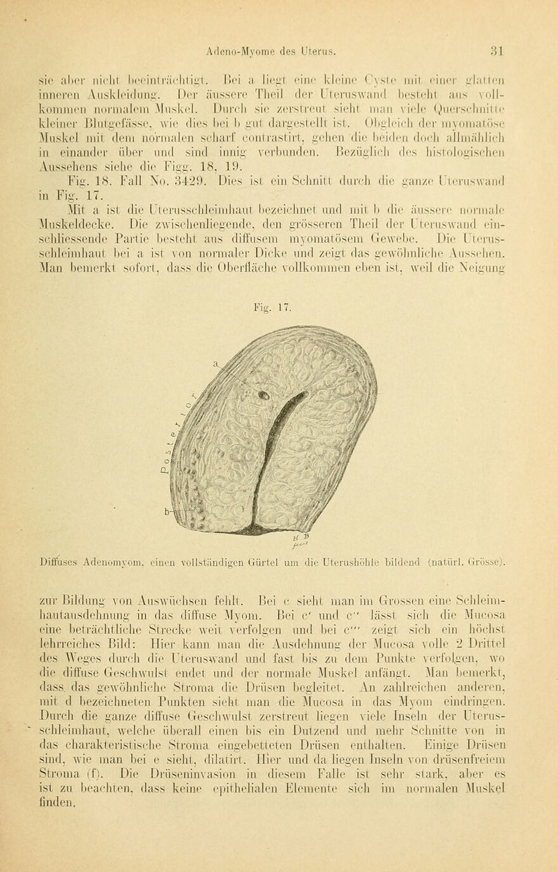 sie alicr nichi beeinträchtigt. Bei a Liegl eine kleine Cyste mii einer glatten inneren Auskleidung. \)r\- äussere Theil der Uteruswand besteh! aus voll- kommen normalem Muskel. Durch sie zerstreul sieht man viele Querschnitte kleiner Blutgefässe, wie dies hei I) gu1 dargestelH ist. Obgleich der myomatöse Muskel mii dem normalen scharf contrastirt, gehen die beiden doch allmählich in einander über und sind innig verbunden. Bezüglich des histologischen Aussehens siehe die Figg. 18, 19. Fig. 18. Fall No. 3429. Dies isi ein Schnitt durch die ganze Uteruswand in Fig. 17. Mit a ist die Uterusschleimhaut bezeichnet und mit l> die äussere normale Muskeldecke. Die zwischenliegende, den grösseren Theil der Uteruswand ein- schliessende Partie besteht aus diffusem myomatösem Gewebe. Die üterus- schleimhaut bei a ist von normaler Dicke und zeigt das gewöhnliche Aussehen. Man bemerkt sofort, dass die Oberfläche vollkommen eben ist, weil die Neigung Yw. 17. Diffuses Adenomyom, einen vollständigen Gürtel um die Uterushöhle bildend (natürl. Grösse). zur Bildung von Auswüchsen fehlt. Bei c sieht man im Grossen eine Schleim- hautausdehnung in das diffuse Myom. Bei C imd c lässt sich die Mucosa eine beträchtliche Strecke weit verfolgen und bei C zeigt sich ein höchst lehrreiches Bild: Hier kann man die Ausdehnung der Mucosa volle 2 Drittel des Weges durch die Uteruswand und fast bis zu dem Punkte verfolgen, wo die diffuse Geschwulst endet und der normale Muskel anfängt. Man bemerkt, dass das gewöhnliche Stroma die Drüsen begleitet. An zahlreichen anderen, mit d bezeichneten Punkten sieht man die Mucosa in das Myom eindringen. Durch die ganze diffuse Geschwulst zerstreut liegen viele Inseln der Uterus- schleimhaut, welche überall einen bis ein Dutzend und mehr Schnitte von in das charakteristische Stroma eingebetteten Drüsen enthalten. Einige Drüsen sind, wie man bei e sieht, dilatirt. Plier und da liegen Inseln von drüsenfreiem Stroma (f). Die Drüseninvasion in diesem Falle ist sehr stark, aber es ist zu beachten, dass keine epithelialen Elemente sich im normalen Muskel finden,