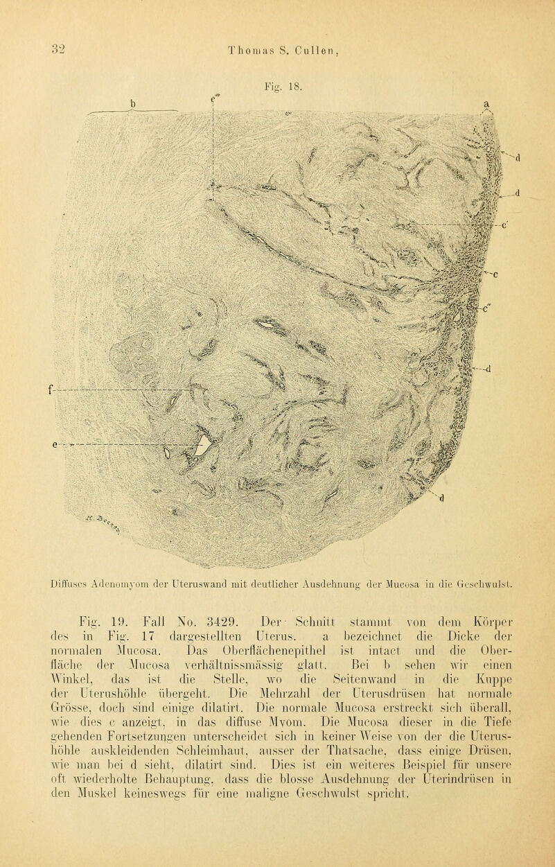 Fie. 18. -d :< ..<: -d , Mm wr~c 1 *i£k<:h-ßl ***£. ' r4¥m e-.T—.-— jr ■'• -1^ d Diffuses Adenomyom clor Uteruswand mit deutlicher Ausdehnung der Mucosa in die Geschwul Fig. 19. Fall No. 3429. Der Schnitt stammt von dorn Körper des in Fig. 17 dargestellten Uterus. a bezeichnet die Dicke der normalen Mucosa. Das Oberflächenepithel ist intacl und die Ober- fläche der Mucosa verhältnissmässig glatt. Bei b sehen wir einen Winkel, das ist die Stelle, wo die Seitenwand in die Kuppe der Uterushöhle übergeht. Die Mehrzahl der Uterusdrüsen hat normale Grösse, doch sind einige clilatirt. Die normale Mucosa erstreckt sich überall, wie dies c anzeigt, in das diffuse Myom. Die Mucosa dieser in die Tiefe gehenden Fortsetzungen unterscheidet sich in keiner Weise von der die Uterus- höhle auskleidenden Schleimhaut, ausser der Thatsache. dass einige Drüsen, wie man bei d sieht, clilatirt sind. Dies ist ein weiteres Beispiel für unsere oft wiederholte Behauptung, dass die blosse Ausdehnung der Uterindrüsen in den Muskel keineswegs für eine maligne Geschwulst spricht.