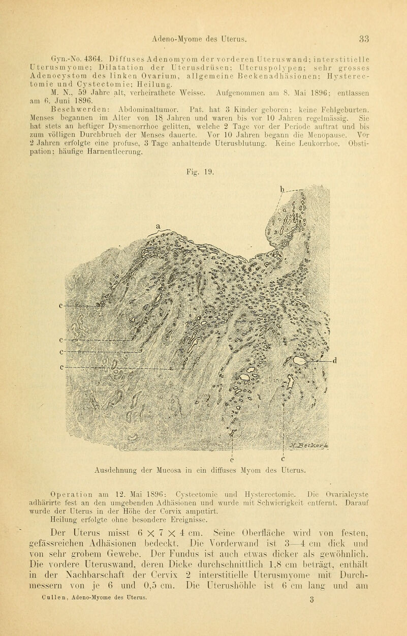 Gyn.-No. 4364. Di ffuses Adcnomyom dervorderen Uterus wand; interstitielle Uterusmyome; Dilatation der Uterusdrüsen; Utcruspolypen; sehr grosses Adenocystora des linken Ovarium, allgemeine Beckenadhäsionen: Hystero- tomie und Cystectomie; Heilung. M. N., 59 Jahre alt, verheirathetc Weisse. Aufgenommen am 8. Mai 1896; entlassen am 6. Juni 1896. Beschwerden: Abdominaltumor. Rat. hat 3 Kinder geboren; keine Fehlgeburten. Menses begannen im Alter von 18 Jahren und waren bis vor 10 Jahren regelmässig. Sic hat stets an heftiger Dysmenorrhoe gelitten, welche 2 Tage vor der Periode auftrat und bis zum völligen Durchbruch der Menses dauerte. Vor 10 Jahren begann die Menopause. Vor 2 Jahren erfolgte eine profuse, 3 Tage anhaltende Uterusblutung. Keine Leukorrhoe. Obsti- pation; häufige Harnentleerung. Fig. 19. a /, Q in- . w:^-.-Ä»/• «\$*r<T„f- -i-fft - .■'.■ /^- ■■■:'■■■■■ ■• . -,- V- X I S - *£ s'V^%-S> r Y \ 1°^S«.-& '^f '^ 5*lHl»*?' /;;,!: :ii.-'<=5_V ?Ä f'a«\*;<' ._.. .-.-.,,, ,i- v*s &? '..V-' ,-; jjr ~> '^°;<iv 1 ^ *^Ä^ ■ %?<*Hq' ° sVl ^ ^Cj-^V - : =' V* IS^S - ' CS -■'.■'»■'' . fK ' c c Ausdehnung der Mucosa in ein diffuses Myom des Uterus. Operation am 12. Mai 1896: Cystectomie und Hysterectomie. Die Ovarialcyste adhärirte fest an den umgebenden Adhäsionen und wurde mit Schwierigkeit entfernt. Darauf wurde der Uterus in der Höhe der Cervix amputirt. Heilung erfolgte ohne besondere Ereignisse. Der Uterus misst 6x^x4 cm. Seine Oberfläche wird von festen, gefässreichen Adhäsionen bedeckt. Die Vorderwand ist 3—4 cm dick und von sehr grobem Gewebe. Der Fundus ist auch etwas dicker als gewöhnlich. Die vordere Uteruswand, deren Dicke durchschnittlich 1,8 cm beträgt, enthält in der Nachbarschaft der Cervix 2 interstitielle Uterusmyome mit Durch- messern von je 6 und 0,5 cm. Die Uterushöhle ist 6 cm lang und am Cullen, Adeno-Myome des Uterus. o