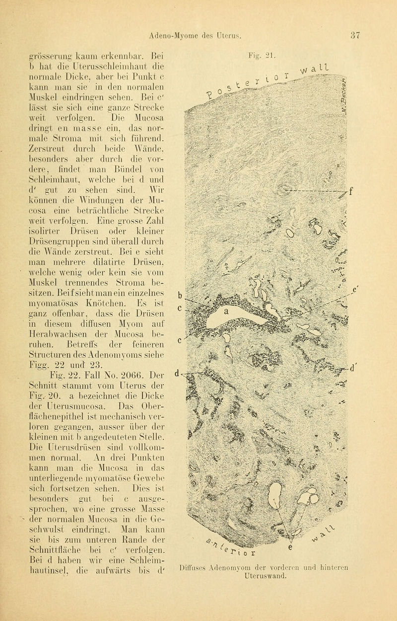 grösserung kaum erkennbar. Bei b hat die Uterusschieimhaul die normale Dicke, abei' bei l'nnkl c kann man sie in den normalen Muskel eindringen sehen. Bei C lässt sie sich eine ganze Strecke Fig. 21. weit verfolgen. Die Mucosa dringt cn mas.se ein, das nor- male Stroma mit sich führend. Zerstreut durch beide Wände, besonders aber durch die vor- dere, findet man Bündel von Schleimhaut, welche bei d und d' gut zu sehen sind. Wir können die Windungen der Mu- cosa eine beträchtliche Strecke weit verfolgen. Eine grosse Zahl isolirter Drüsen oder kleiner Drüsengruppen sind überall durch die Wände zerstreut. Bei e sieht man mehrere dilatirte Drüsen, welche wenig oder kein sie vom Muskel trennendes Stroma be- sitzen. Beifsiehtmanein einzelnes myomatösas Knötchen. Es ist ganz offenbar, dass die Drüsen in diesem diffusen Myom auf Herabwachsen der Mucosa be- ruhen. Betreffs der feineren Strukturen des Adenomyoms siehe Figg. 22 und 23. Fig. 22. Fall No. 2066. Der Schnitt stammt vom Uterus der Fig/ 20. a bezeichnet die Dicke der Uterusmucosa. Das Ober- flächenepithel ist mechanisch ver- loren gegangen, ausser über der kleinen mit b angedeuteten Stelle. Die Uterusdrüsen sind, vollkom- men normal. An drei Punkten kann man die Mucosa in das unterliegende myomatöse Gewebe sich fortsetzen sehen. Dies ist besonders gut bei c ausge-, sprochen, wo eine grosse Masse der normalen Mucosa in die Ge- schwulst eindringt. Man kann bis zum unteren Rande der sie Schnittfläche Bei d haben bei wir c' verfolgen, eine Schleim- hautinsel, die aufwärts bis d' VJ LI \ o ,.-;,■ 5 I 1 ^J W: m .■e=5v HS ^ :kM 4>. *( %rJ^~ ^ vv en o r Diffuses Adenomyom der vorderen und hinteren Uteruswand.