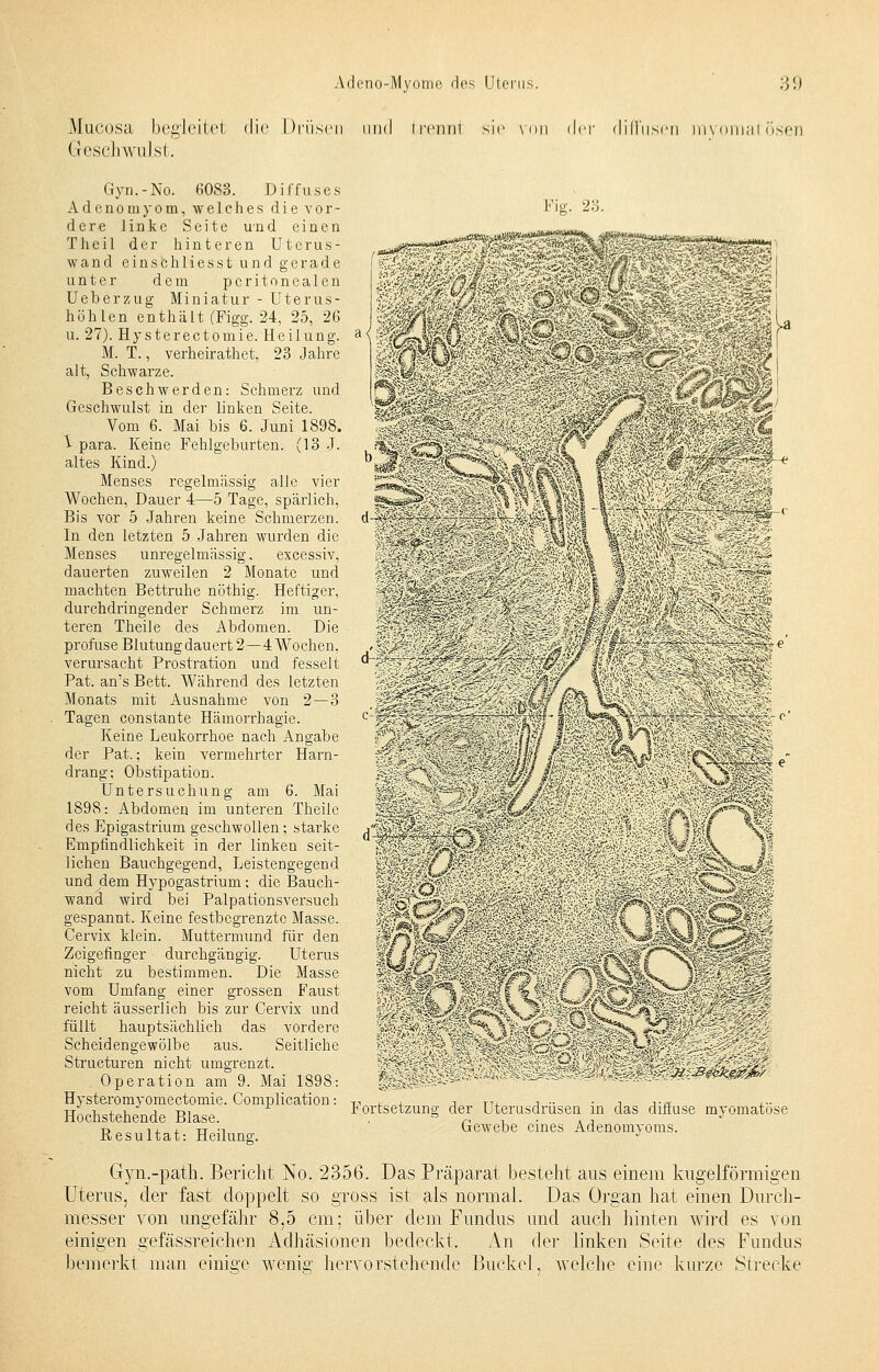 Mucosa begleite! die Drüsen und tremil sie von der diffusen niyomatösen Geschwulst. Gyn.-No. 6083. Diffuses Adenomyom, welches die vor- dere linke Seite und einen Tlieil der hinteren Uterus- wand einschliesst und gerade unter dem peritonealen Ueberzug Miniatur - Uterus- höhlen enthält (Figg. 24, 25, 26 u. 27). Hysterectomie. Heilung. M. T., verheirathet, 23 Jahre alt, Schwarze. Beschwerden: Schmerz und Geschwulst in der linken Seite. Vom 6. Mai bis 6. Juni 1898. i- para. Keine Fehlgeburten. (13 J. altes Kind.) Menses regelmässig alle vier Wochen, Dauer 4—5 Tage, spärlich, Bis vor 5 Jahren keine Schmerzen. In den letzten 5 Jahren wurden die Menses unregelmässig, excessiv, dauerten zuweilen 2 Monate und machten Bettruhe nöthig. Heftiger, durchdringender Schmerz im un- teren Theile des Abdomen. Die profuse Blutung dauert 2—4 Wochen, verursacht Prostration und fesselt Pat. an's Bett. Während des letzten Monats mit Ausnahme von 2—3 Tagen constante Hämorrhagie. Keine Leukorrhoe nach Angabe der Pat.; kein vermehrter Harn- drang: Obstipation. Untersuchung am 6. Mai 1898: Abdomen im unteren Theile des Epigastrium geschwollen; starke Empfindlichkeit in der linken seit- lichen Bauchgegend, Leistengegend und dem Hypogastrium: die Bauch- wand wird bei Palpationsversuch gespannt. Keine festbegrenzte Masse. Cervix klein. Muttermund für den Zeigefinger durchgängig. Uterus nicht zu bestimmen. Die Masse vom Umfang einer grossen Faust reicht äusserlich bis zur Cervix und füllt hauptsächlich das vordere Scheidengewölbe aus. Seitliche Structuren nicht umgrenzt. Operation am 9. Mai 1898: Hysteromyomectomie. Complication: Hochstehende Blase. Resultat: Heilung. a< Fig. 23. ■y/r^H--'S^r->:/i:'.rs:f'V-;.. . .. ' • '; * / i *,»' • ' •.: -' Mm& :^«Ä 9MWg'i wmm ntf ... r ^Z. SA- ■■/,.J:} 1 •&; K'Ji:.iÄ4 Fortsetzung der Uterusdrüsen in das diffuse myomatöse Gewebe eines Adenomyoms. Gyn.-path. Bericht No. 2356. Das Präparat besteht aus einem kugelförmigen Uterus, der fast doppelt so gross ist als normal. Das Organ hat einen Durch- messer von ungefähr 8,5 cm: über dem Fundus und auch hinten wird es von einigen gefässreichen Adhäsionen bedeckt. An der linken Seite des Fundus bemerkt man einige wenig hervorstehende Buckel, welche eine kurze Strecke