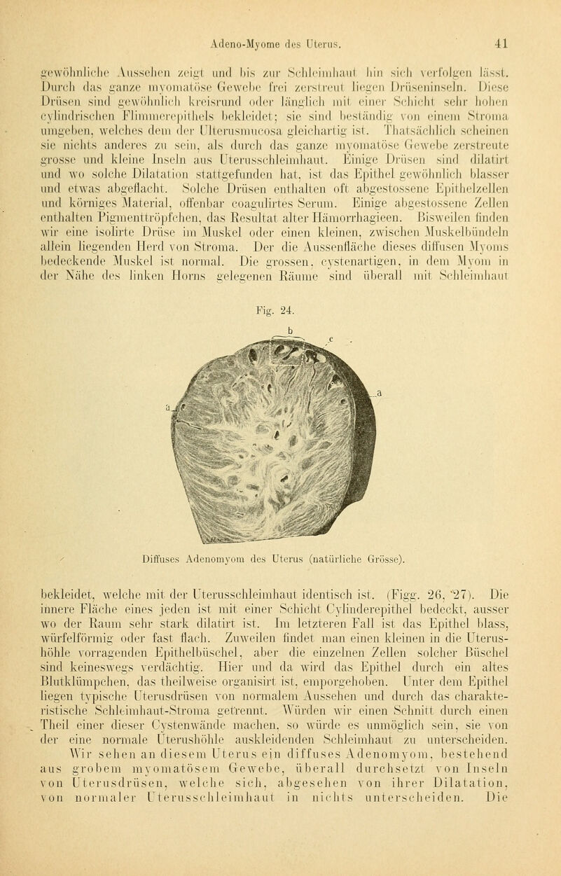 gewöhnliche Aussehen zeigi and bis zur Schleimhaul liin sich verfolgen lässt. Durch das ganze myomatöse Gewebe frei zerstreul liegen Drüseninseln. Diese Drüsen sind gewöhnlich kreisrund oder Länglich mit einer Schichl sehr hohen cylindrischen Flimmerepithels bekleidet; sie sind beständig von einem Stroma umgeben, welches dem der Ulterusmucosa gleichartig ist. Thatsächlich scheinen sie nichts anderes zu sein, als durch das ganze myomatöse Gewebe zerstreute grosse und kleine Inseln aus Uterusschleimhaut. Einige Drüsen sind dilatiri und wo solche Dilatation stattgefunden hat, ist das Epithel gewöhnlich blasser und etwas abgeflacht, Solche Drüsen enthalten oft abgestossene Epithelzellen und körniges Material, offenbar coagulirtes Serum. Einige abgestossene Zellen enthalten Pigmenttröpfchen, das Resultat alter Hämorrhagieen. Bisweilen finden wir eine isolirte Drüse im Muskel oder einen kleinen, zwischen Muskelbündeln allein liegenden Herd von Stroma. Der die Aussenfläche dieses diffusen Myoms bedeckende Muskel ist normal. Die grossen, cystenartigen, in dem Myom in der Nähe des linken Horns gelegenen Räume sind überall mit Schleimhaut a_i# Diffuses Adenomyom des Uterus (natürliche Grösse). bekleidet, welche mit der Uterusschleimhaut identisch ist. (Figg. 26, ,l27). Die innere Fläche eines jeden ist mit einer Schicht Cylinderepithel bedeckt, ausser wo der Raum sehr stark dilatirt ist. Im letzteren Fall ist das Epithel blass, würfelförmig oder fast flach. Zuweilen findet man einen kleinen in die Uterus- höhle vorragenden Epithelbüschel, aber die einzelnen Zellen solcher Büschel sind keineswegs verdächtig. Hier und da wird das Epithel durch ein altes Blutklümpchen, das theilweise organisirt ist, emporgehoben. Unter dem Epithel liegen typische Uterusdrüsen von normalem Aussehen und durch das charakte- ristische Schleimhaut-Stroma getrennt. Würden wir einen Schnitt durch einen Theil einer dieser Cystenwände machen, so würde es unmöglich sein, sie von der eine normale Uterushöhle auskleidenden Schleimhaut zu unterscheiden. Wir sehen an diesem Uterus ein diffuses Adenomyom, bestehend aus grobem myomatösem Gewebe, überall durchsetzt von Inseln von Uterusdrüsen, welche sich, abgesehen von ihrer Dilatation, von normaler Uterusschleimhaut in nichts unterscheiden. Die