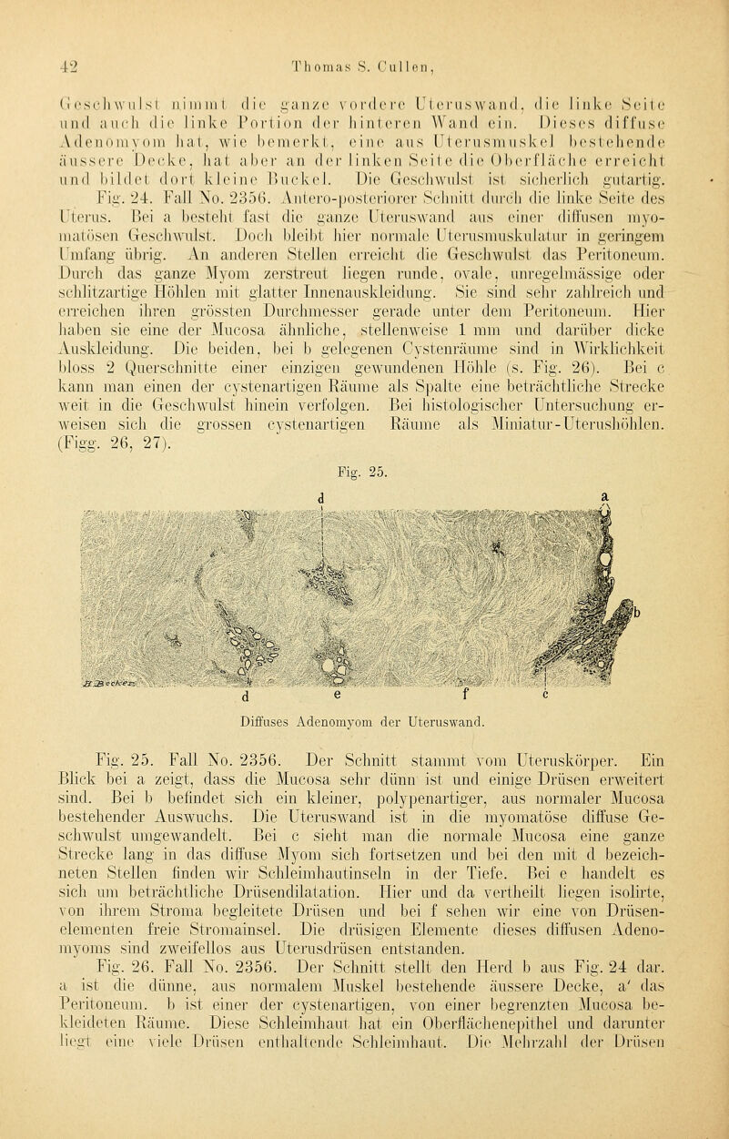 Geschwulsl nimmt die ganze vordere Uteruswand, die linke Seile und auch die linke Portion der hinteren Wund ein. Dieses diffuse Adennmvom hat, wie bemerkt, eine aus Uterusm iiskel bestehende äussere Decke, hat aber an der linken Seite die Oberfläche erreicht und bildet dort kleine Buckel. Die Gesehwulst ist sicherlich gutartig. Fig. 24. Fall No. 2356. Antero-posteriorer Schnitt durch die linke Seite des Uterus. Bei a bestellt fast die ganze Uteruswand aus einer diffusen mvo- matösen Geschwulst. Doch bleibt hier normale Uterusmuskulatur in geringem Umfang übrig. An anderen Stellen erreicht die Geschwulst das Peritoneum. Durch das ganze Myom zerstreut liegen runde, ovale, unregelmässige oder schlitzartige Höhlen mit glatter Innenauskleidung. Sie sind sehr zahlreich und erreichen ihren grössten Durchmesser gerade unter dem Peritoneum. Hier haben sie eine der Mucosa ähnliche, stellenweise 1 mm und darüber dicke Auskleidung. Die beiden, bei b gelegenen Oystenräume sind in Wirklichkeit bloss 2 Querschnitte einer einzigen gewundenen Höhle (s. Fig. 26). Bei c kann man einen der cystenartigen Räume als Spalte eine beträchtliche Strecke weit in die Geschwulst hinein verfolgen. Bei histologischer Untersuchung er- weisen sich die grossen cystenartigen Räume als Miniatur-Uterushöhlen. (Figg. 26, 27). Fig. 25. ^«^•&&>''- ':■ ' n^aR? ■ | '■' ■ ' . - ' ■' ~ >*% ■ ' . «.■* -~- ' 'j ' ic'ZBiete'ei*. ' ■■.,'- ' ;.- , mz-ü ■■::. <P ' y .■•^'i^k: ■ d e f c Diffuses Adenomyom der Uteruswand. Fig. 25. Fall No. 2356. Der Schnitt stammt vom Uteruskörper. Ein Blick bei a zeigt, dass die Mucosa sehr dünn ist und einige Drüsen erweitert sind. Bei b befindet sich ein kleiner, polypenartiger, aus normaler Mucosa bestehender Auswuchs. Die Uteruswand ist in die myomatöse diffuse Ge- schwulst umgewandelt. Bei c sieht man die normale Mucosa eine ganze Strecke lang in das diffuse Myom sich fortsetzen und bei den mit d bezeich- neten Stellen finden wir Schleimhautinseln in der Tiefe. Bei e handelt es sich um beträchtliche Drüsendilatation. Hier und da vertheilt liegen isolirte, von ihrem Stroma begleitete Drüsen und bei f sehen wir eine von Drüsen- elementen freie Stromainsel. Die drüsigen Elemente dieses diffusen Adeno- myoms sind zweifellos aus Uterusdrüsen entstanden. Fig. 26. Fall No. 2356. Der Schnitt stellt den Herd b aus Fig. 24 dar. a ist die dünne, aus normalem Muskel bestehende äussere Decke, a' das Peritoneum, b ist einer der cystenartigen, von einer begrenzten Mucosa be- kleideten Räume. Diese Schleimhaut hat ein Oberflächenepithel und darunter liegt eine viele Drüsen enthaltende Schleimhaut. Die .Mehrzahl der Drüsen
