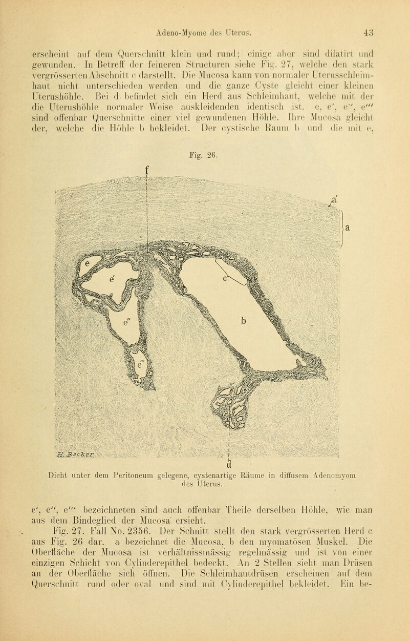 erschein! auf dem Querschnitt klein and rund: einige aber sind dilatiri und gewunden. In Betreff der feineren Structuren siehe Fig. 27, welche den stark vergrösser!cii Abschnitt c darstellt. Die Mucosa kann \ ob normaler Uterusschleim- hani niehi unterschiedeu werden und die ganze Cyste gleichl einer kleinen Uterushöhle. Bei d. befindet sich ein Herd aus Schleimhaut, welche mii <\^ die Uterushöhle normaler Weise auskleidenden identisch ist. e, e', e, e' sind offenbar Querschnitte einer viel gewundenen Höhle. Ihre Mucosa gleichl der. welche die Bohle b bekleidet. Der cystische Kanin I» \\\\t\ die niii e, Fig. 26. ,a 4... n H. Becker, Dicht unter dem Peritoneum gelegene, cystenartige Räume in diffusem Adenomyom des Uterus. e', e, e' bezeichneten sind auch offenbar Theile derselben Höhle, wie man aus dem Bindeglied der Mucosa' ersieht. Fig. 27. Fall No. 2356. Der Schnitt stellt den stark vergrösserten Herd c aus Fig. 26 dar. a bezeichnet die Mucosa, b den myomatösen Muskel. Die Oberfläche der Mucosa ist verhältnissmässig regelmässig und ist von einer einzigen Schicht von Oylinderepithel bedeckt. An 2 Stellen sieht man Drüsen an der Oberfläche sich öffnen. Die Schleimhautdrüsen erscheinen auf dem Querschnitt rund oder oval und sind mit Oylinderepithel bekleidet. Ein be-