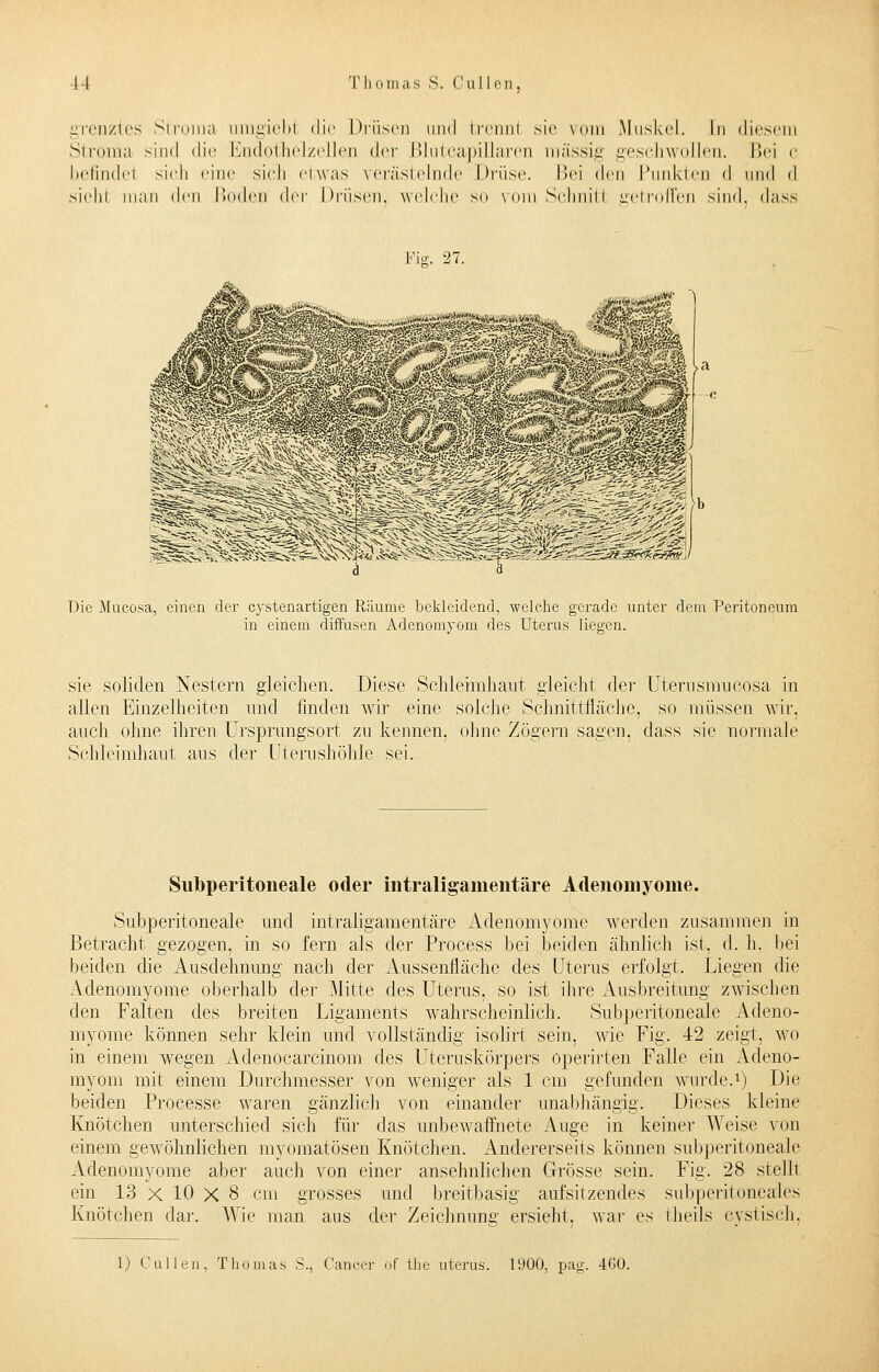 grenztes Strom a umgiebl die Driisei] und trennl sie vorn Muskel. In diesem Stroma sind die Endothelzellen der BluteapiUaren massig geschwollen. Bei c befindel sich eine sich etwas verästelnde Drüse. Bei den Pnnkteu d and d siehi man den Boden der Drüsen, welche so vom Schnitl getroffen sind, dass Fig. 27. Die Mucosa, einen der cystenartigen Räume bekleidend, welche gerade unter dem Peritoneum in einem diffusen Adenomyom des Uterus liegen. sie soliden Nestern gleichen. Diese Schleimhaut gleicht der Uterusinucosa in allen Einzelheiten und finden wir eine solche Schnittfläche, so müssen wir. auch ohne ihren Ursprungsort zu keimen, ohne Zögern sagen, dass sie normale Schleimhaut aus der Uterushöhle sei. Subperitoneale oder intraliganientäre Adenomyome. Subperitoneale und intraligamentäre Adenomyome werden zusammen in Betracht gezogen, in so fern als der Process bei beiden ähnlich ist. d. h. bei beiden die Ausdehnung nach der Aussenfläche des Uterus erfolgt. Liegen die Adenomyome oberhalb der Mitte des Uterus, so ist ihre Ausbreitung zwischen den Falten des breiten Ligaments wahrscheinlich. Subperitoneale Adeno- myome können sehr klein und vollständig isolirt sein, wie Fig. 42 zeigt, wo in einem wegen Adenocarcinom des Uteruskörpers operirten Falle ein Adeno- myom mit einem Durchmesser von weniger als 1 cm gefunden wurde.1) Die beiden Processe waren gänzlich von einander unabhängig. Dieses kleine Knötchen unterschied sich für das unbewaffnete Auge in keiner Weise von einem gewöhnlichen myomatösen Knötchen. Andererseits können subperitoneale Adenomyome aber auch von einer ansehnlichen Grösse sein. Fig. 28 stellt ein 13 x 10 X 8 cm grosses und breitbasig aufsitzendes subperitoneales Knötchen dar. Wie man aus der Zeichnung ersieht, war es theils cystisch, 1) Cullen, Thomas S., Cancer of the uterus. 1900, pag. 4G0.