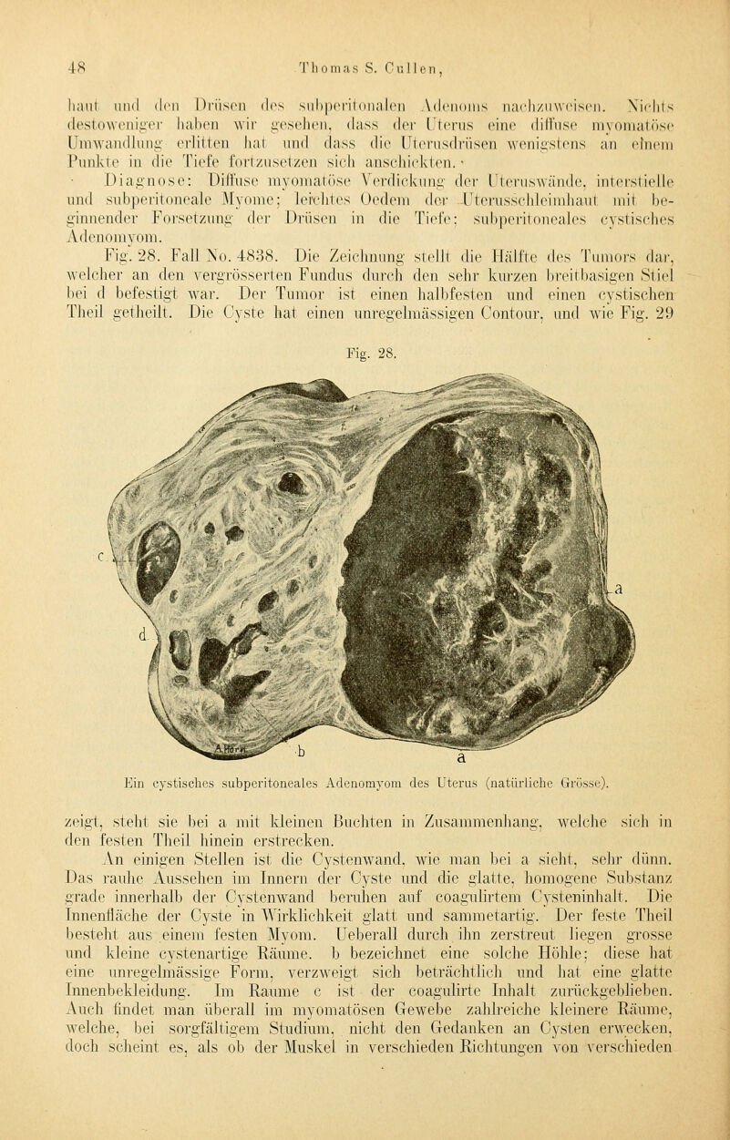 haut und den Drüsen des subperitonalen Adenoms nachzuweisen. Nichts destoweniger haben wir gesehen, dass der Uterus eine diffuse myomatöse Umwandlung erlitten hai und dass die Uterusdrüsen wenigstens an einem Punkte in die Tiefe fortzusetzen sich anschickten. Diagnose: Diffuse myomatöse Verdickung der Uteruswände, interstielle und subperitoneale Myome: leichtes (Jedem der Uterusschleimhaul mit be- ginnender Forsetzung der Drüsen in die Tiefe; subperitoneales cystisches Adenom vom. Fig. 28. Fall No. 4838. Die Zeichnung stelH die Hälfte des Tumors dar. welcher an den vergrösserten Fundus durch den sehr kurzen breit basigen Stiel bei d befestigt war. Der Tumor ist einen halbfesten und einen cystischen Theil getheilt. Die Cyste hat einen unregelmässigen Contour, und wie Fig. 29 Fig. 28. Ein cystisches subperitoneales Adenomyom des Uterus (natürliche Grösse). zeigt, steht sie bei a mit kleinen Buchten in Zusammenhang, welche sich in den festen Theil hinein erstrecken. An einigen Stellen ist die Cystenwand, wie man bei a sieht, sehr dünn. Das rauhe Aussehen im Innern der Cyste und die glatte, homogene Substanz grade innerhalb der Cystenwand beruhen auf coagulirtem Cysteninhalt. Die Innenfläche der Cyste in Wirklichkeit glatt und sammetartig. Der feste Theil besteht aus einem festen Myom. Ueberall durch ihn zerstreut liegen grosse und kleine cystenartige Räume, b bezeichnet eine solche Höhle: diese hat eine unregelmässige Form, verzweigt sich beträchtlich und hat eine glatte Innenbekleidung. Im Räume c ist der coagulirte Inhalt zurückgeblieben. Auch findet man überall im myomatösen Gewebe zahlreiche kleinere Räume, welche, bei sorgfältigem Studium, nicht den Gedanken an Cysten erwecken, doch scheint es, als ob der Muskel in verschieden Richtungen von verschieden