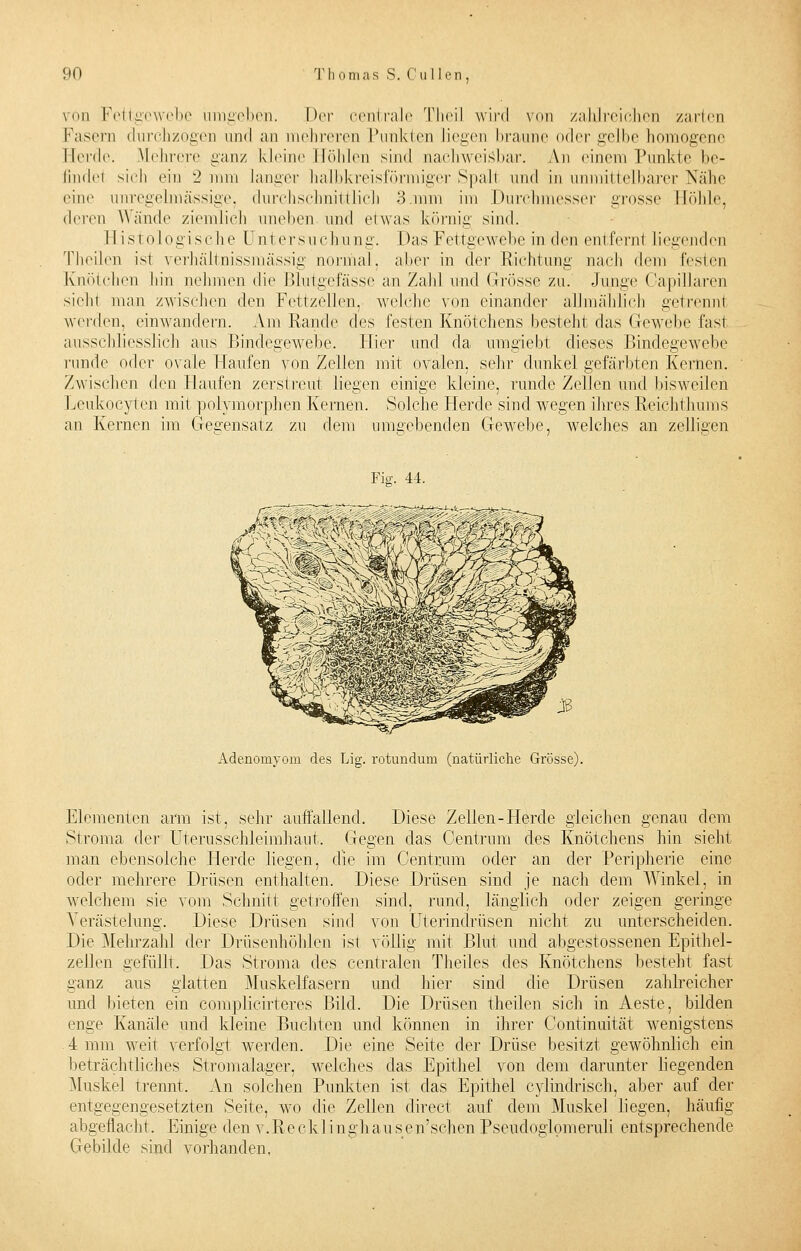 vod Fettgewebe umgeben. Der centrale Theil wird von zahlreichen zarten Fasern durchzogen und an mehreren Punkten liegen braune oder gelbe homogene Herde. Mehrere ganz kleine Mühlen sind nachweisbar. An einem Punkte be- finde sich ein 2 nun langer halbkreisförmiger Spalt und in unmittelbarer Nähe eine unregelmässige, durchschnittlich 3.mm im Durchmesser grosse Höhle. deren Wände ziemlich uneben und etwas körnig sind. Histologische Untersuchung. Das Fettgewebe in den entfernt liegenden Theilen ist verhältnissmässig normal. aber in der Richtung nach dem festen Knötchen hin nehmen die Blutgefässe an Zahl und Grösse zu. Junge Oapillaren sieht man zwischen den Fettzellen, welche von einander allmählich getrennt Verden, einwandern. Am Rande des festen Knötchens besteht das Gewebe fast ausschliesslich aus Bindegewebe. Hier und da umgiebt dieses Bindegewebe runde oder ovale Haufen von Zellen mit ovalen, sehr dunkel gefärbten Kernen. Zwischen den Haufen zerstreut liegen einige kleine, runde Zellen und bisweilen Leukoeyten mit polymorphen Kernen. Solche Herde sind wegen ihres Reichthums an Kernen im Gegensatz zu dem umgebenden Gewebe, welches an zelligen Fig. 44. Adenomyom des Lig. rotundum (natürliche Grösse). Elementen arm ist, sehr auffallend. Diese Zellen-Herde gleichen genau dem Stroma der Uterusschleimhaut, Gegen das Gentrum des Knötchens hin sieht man ebensolche Herde liegen, die im Centrum oder an der Peripherie eine oder mehrere Drüsen enthalten. Diese Drüsen sind je nach dem Winkel, in welchem sie vom Schnitt getroffen sind, rund, länglich oder zeigen geringe Verästelung. Diese Drüsen sind von Uterindrüsen nicht zu unterscheiden. Die Mehrzahl der Drüsenhöhlen ist völlig mit Blut und abgestossenen Epithel- zellen gefüllt. Das Stroma des centralen Theiles des Knötchens besteht fast ganz aus glatten Muskelfasern und hier sind die Drüsen zahlreicher und bieten ein complicirteres Bild. Die Drüsen theilen sich in Aeste, bilden enge Kanäle und kleine Buchten und können in ihrer Continuität wenigstens -4 mm weit verfolgt werden. Die eine Seite der Drüse besitzt gewöhnlich ein beträchtliches Stromalager, welches das Epithel von dem darunter liegenden Muskel trennt. An solchen Punkten ist das Epithel cylindrisch, aber auf der entgegengesetzten Seite, wo die Zellen direct auf dem Muskel liegen, häufig abgeflacht. Einige den v.RcckIinghausen'schenPseudoglomeruli entsprechende Gebilde sind vorhanden.