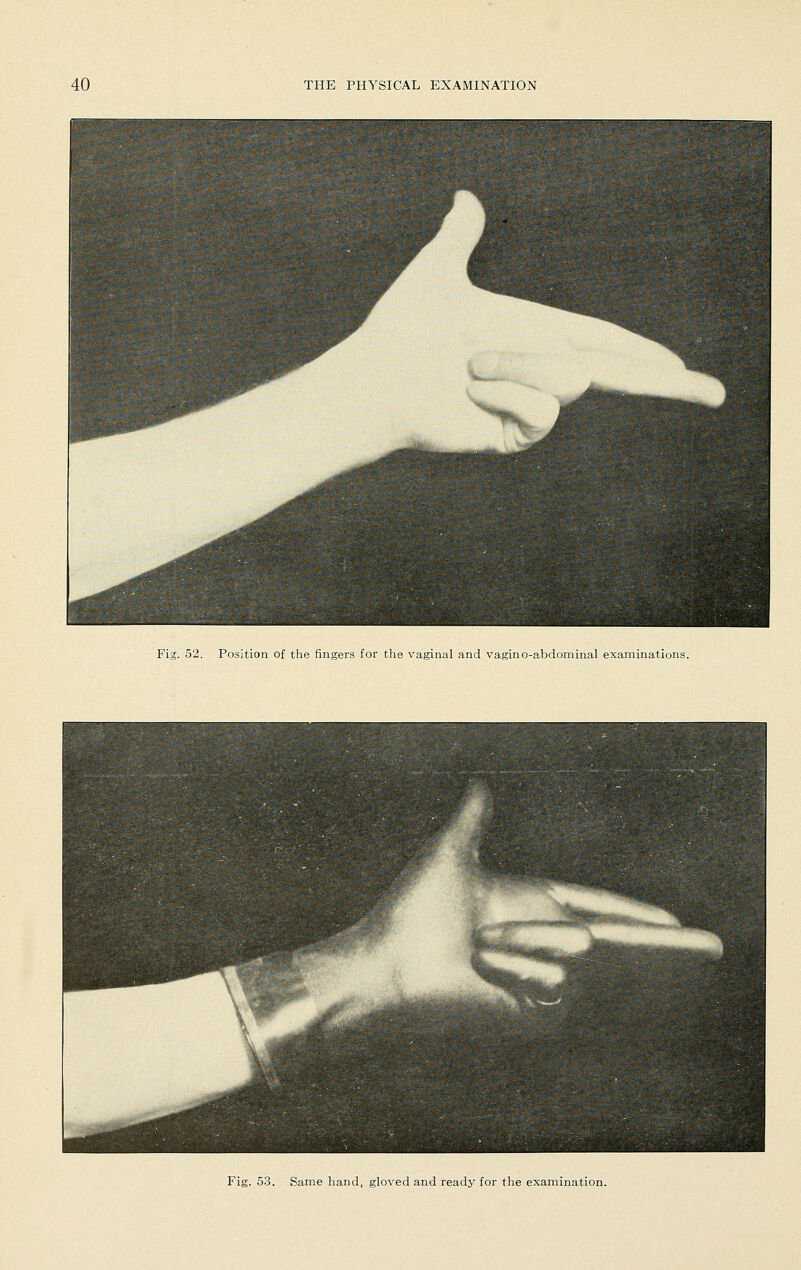 Fig. 52. Position of tlie fingers for the vaginal and vagino-abdominal examinations. Fig. 53. Same hand, gloved and ready for the examination.