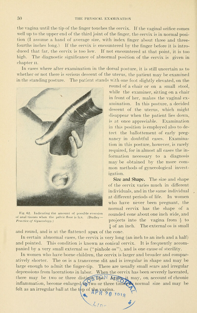 the vagina until the tip of the finger touclies the cervix. If the vaginal orifice comes well up to the upper end of the third joint of the finger, the cervix is in normal posi- tion (I assume a hand of average size, with index finger about three and three- fourths inches long.) If the cervix is encountered by the finger before it is intro- duced that far, the cervix is too low. If not encountered at that point, it is too high. The diagnostic significance of abnormal position of the cervix is given in chapter ii. In cases where after examination in the dorsal posture, it is still uncertain as to whether or not there is serious descent of the uterus, the patient may be examined in the standing posture. The patient stands with one foot shghtly elevated, on the round of a chair or on a small stool, while the examiner, sitting on a chair in front of her, makes the vaginal ex- amination. In this posture, a decided descent of the uterus, which might disappear when the patient lies down, is at once appreciable. Examination in this position is employed also to de- tect the ballottement of early preg- nancy in doubtful cases. Examina- tion in this posture, however, is rarely required, for in almost all cases the in- formation necessary to a diagnosis may be obtained by the more com- mon methods of gynecological invest- igation. Size and Shape. The size and shape of the cervix varies much in different individuals, and in the same individual at different periods of life. In women who have never been pregnant, the normal cervix has the shape of a rounded cone about one inch wide, and projects into the vagina from ^ to f of an inch. The external os is small and round, and is at the flattened apex of the cone. In certain abnormal cases, the cervix is very long (an inch to an inch and a half) and pointed. This condition is known as conical cervix. It is frequently accom- panied by a very small external os (pinhole os), and is one cause of sterility. In women who have borne children, the cervix is larger and broader and compar- atively shorter. The os is a transverse slit and is irregular in shape and may be large enough to admit the finger-tip. There are usually small scars and irregular depressions from lacerations in labor. When_the cervix has been severely lacerated, there may be two or three distkn^Tijp^N ^Sf^I^>4i ^^Yf o^ account of chronic inflammation, become enlarged/^Two or three timd^^normal size and may be felt as an irregular ball at the tpp of ifhe. vagina. \\ 4. Fig. 62. Indicating the amount of possible eversion of anal tissues when the pelvic floor is lax. (Dudley — Practice of Gynecoloc/;/.)